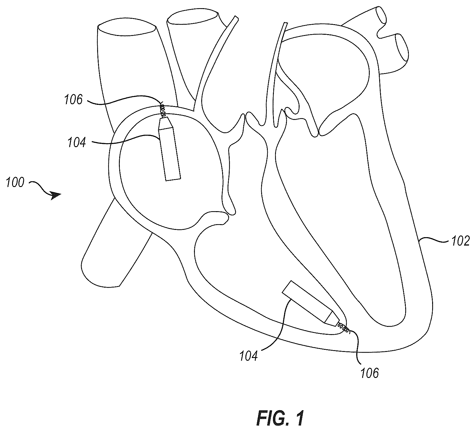 Patent US12564723 — Implant delivery and retrieval systems and methods — Figure 1