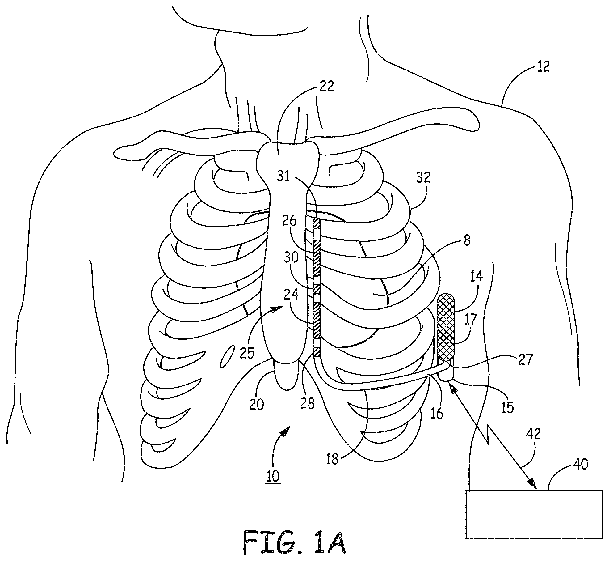 Patent US12569184 — Cardiac electrical signal gross morphology-based noise detection for rejection of ventricular tachyarrhythmia detection — Figure 1