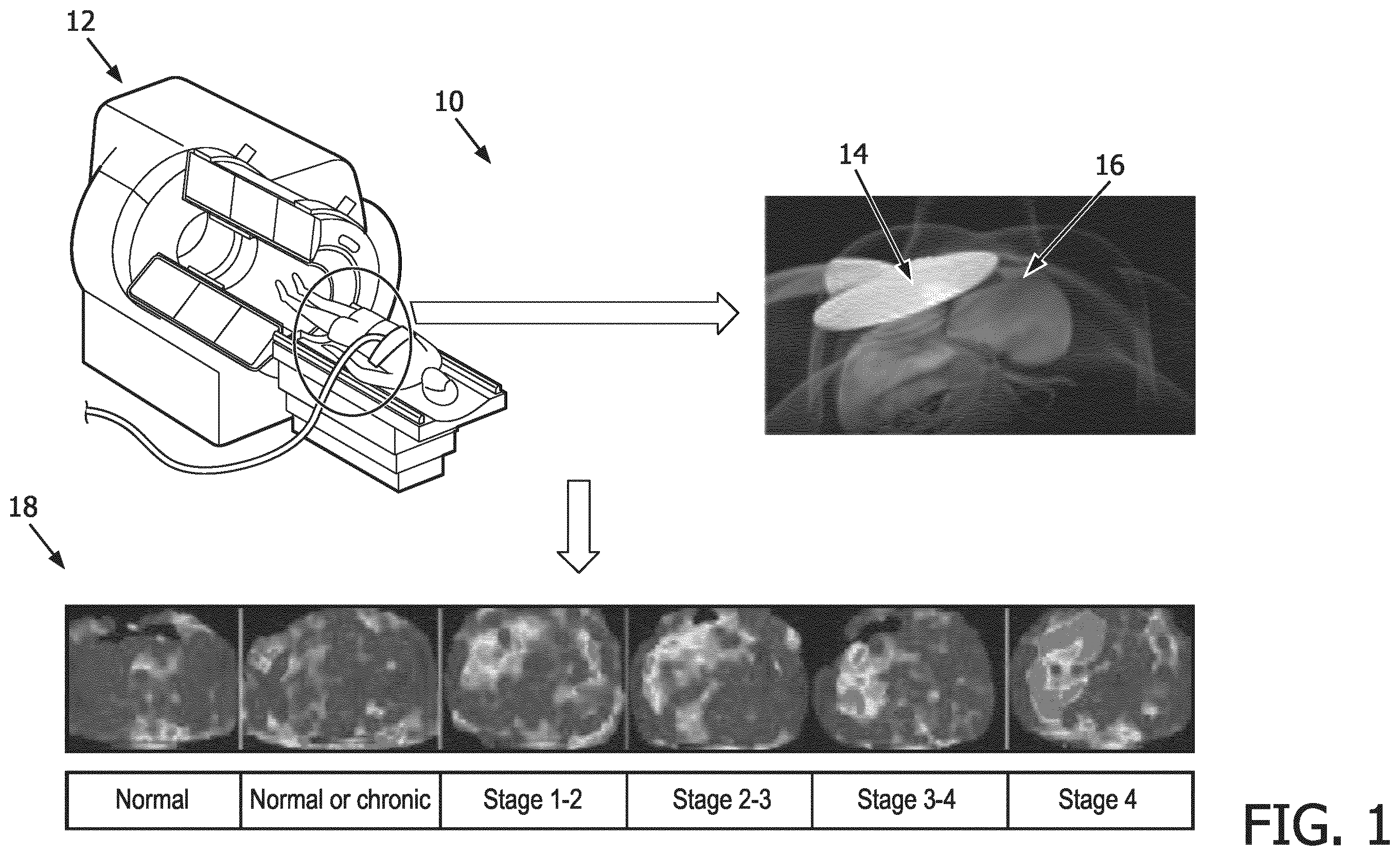 Patent US12569186 — Apparatus and method for augmented interpretation of magnetic resonance and ultrasound shear wave elastography for monitoring liver fibrosis — Figure 1