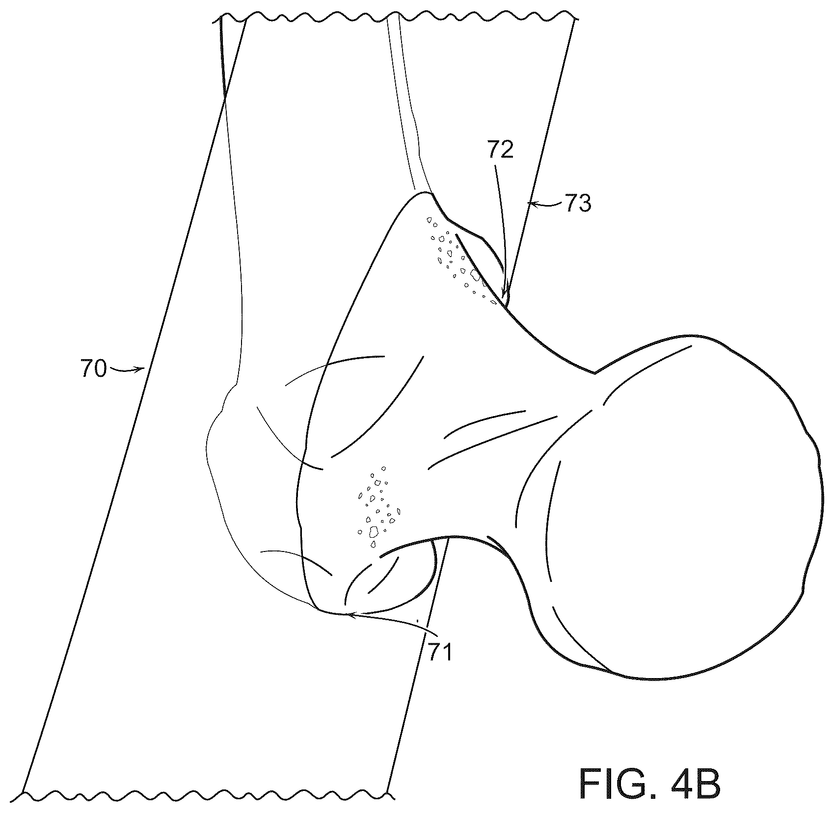 Patent US12569260 Figure 5 – Controls for power tools or instruments including bone saws and drills including safety and directional control and haptic feedback