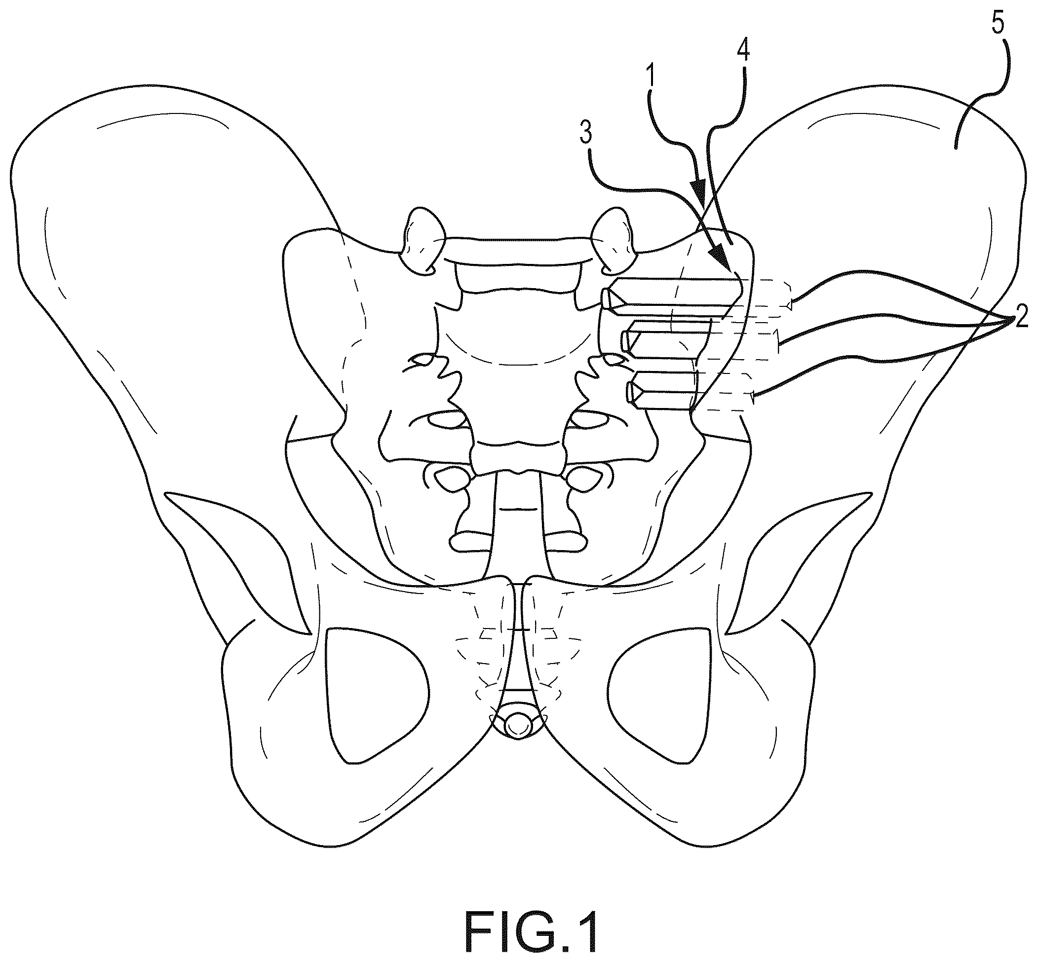 Patent US12569262 — Decortication instrumentation for posterior sacroiliac joint fusion — Figure 1