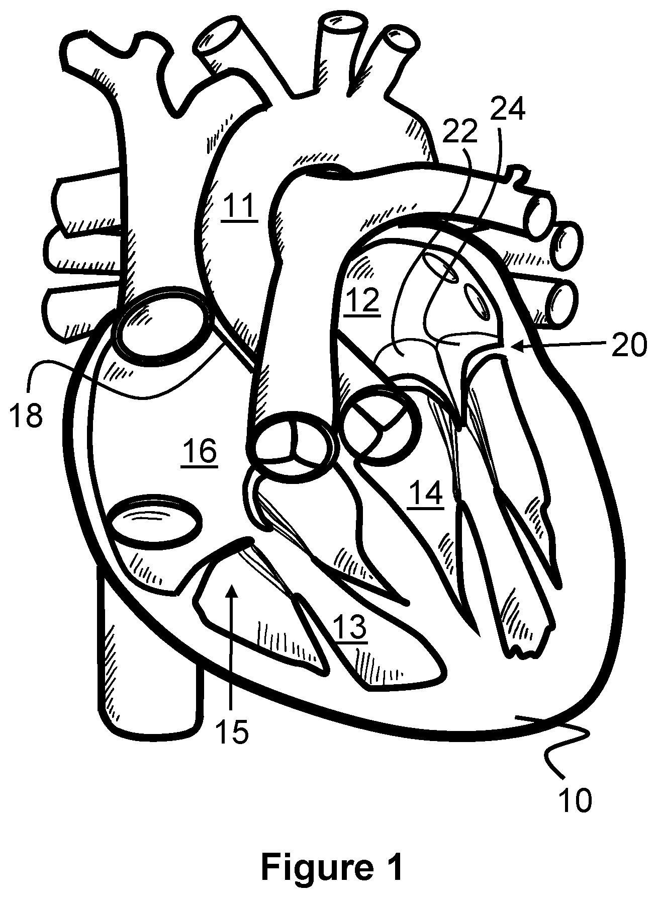 Patent US12569274 Figure 1 – Method and apparatus for removing heart valve therapy