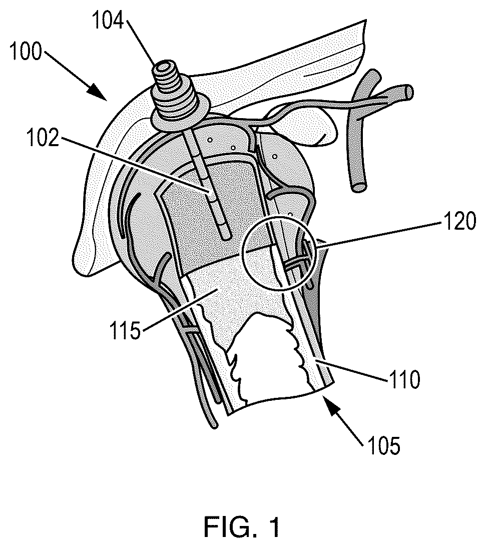 Patent US12569277 Figure 1 – Intraosseous catheter placement confirmation device and method