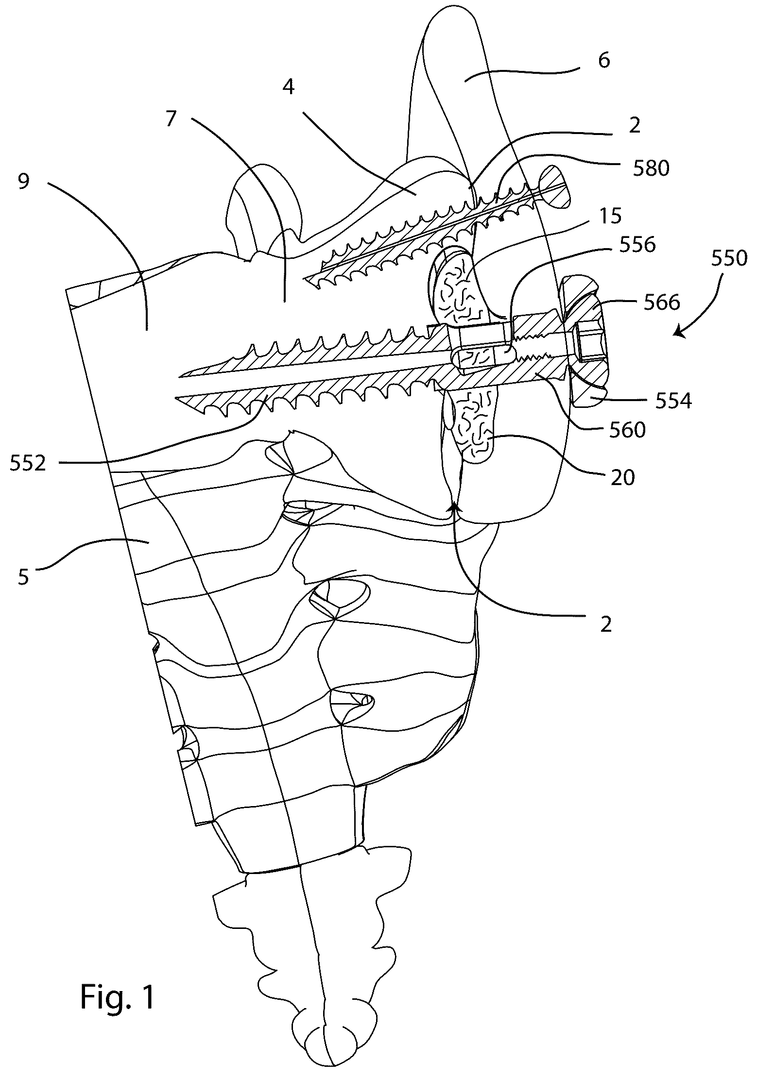 Patent US12569280 — Joint fusion implant and methods — Figure 1