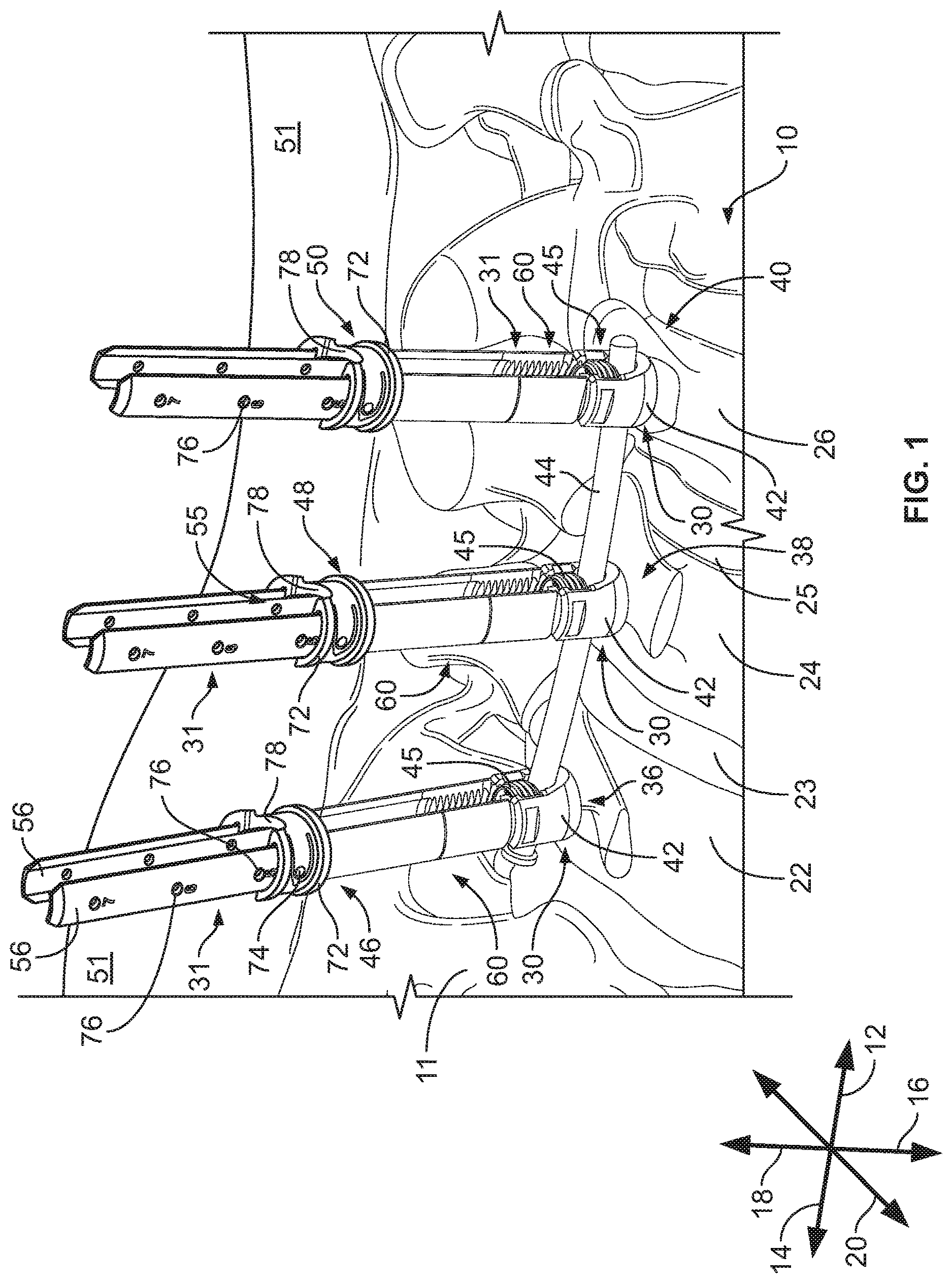 Patent US12569282 — Tissue retraction and vertebral displacement devices, systems, and methods for posterior spinal fusion — Figure 1