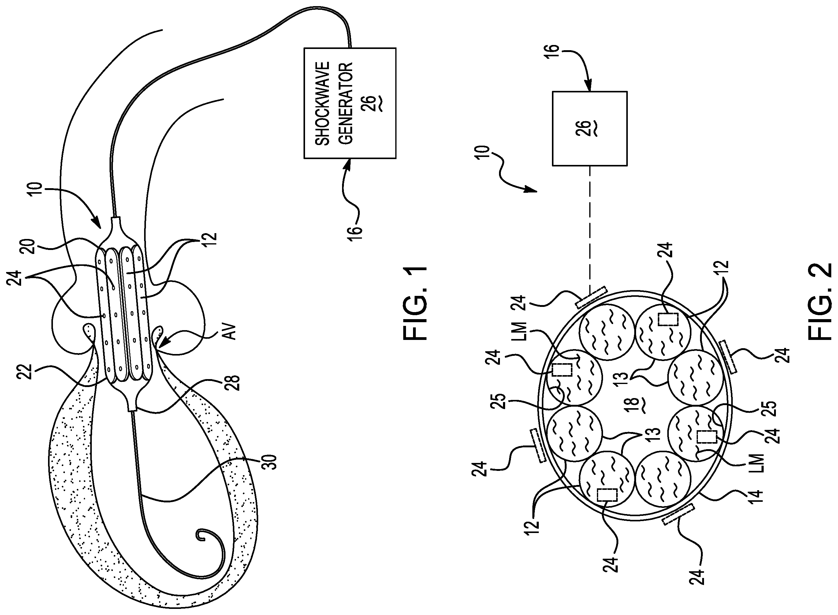Patent US12569339 — Aortic valve lithotripsy balloon — Figure 1