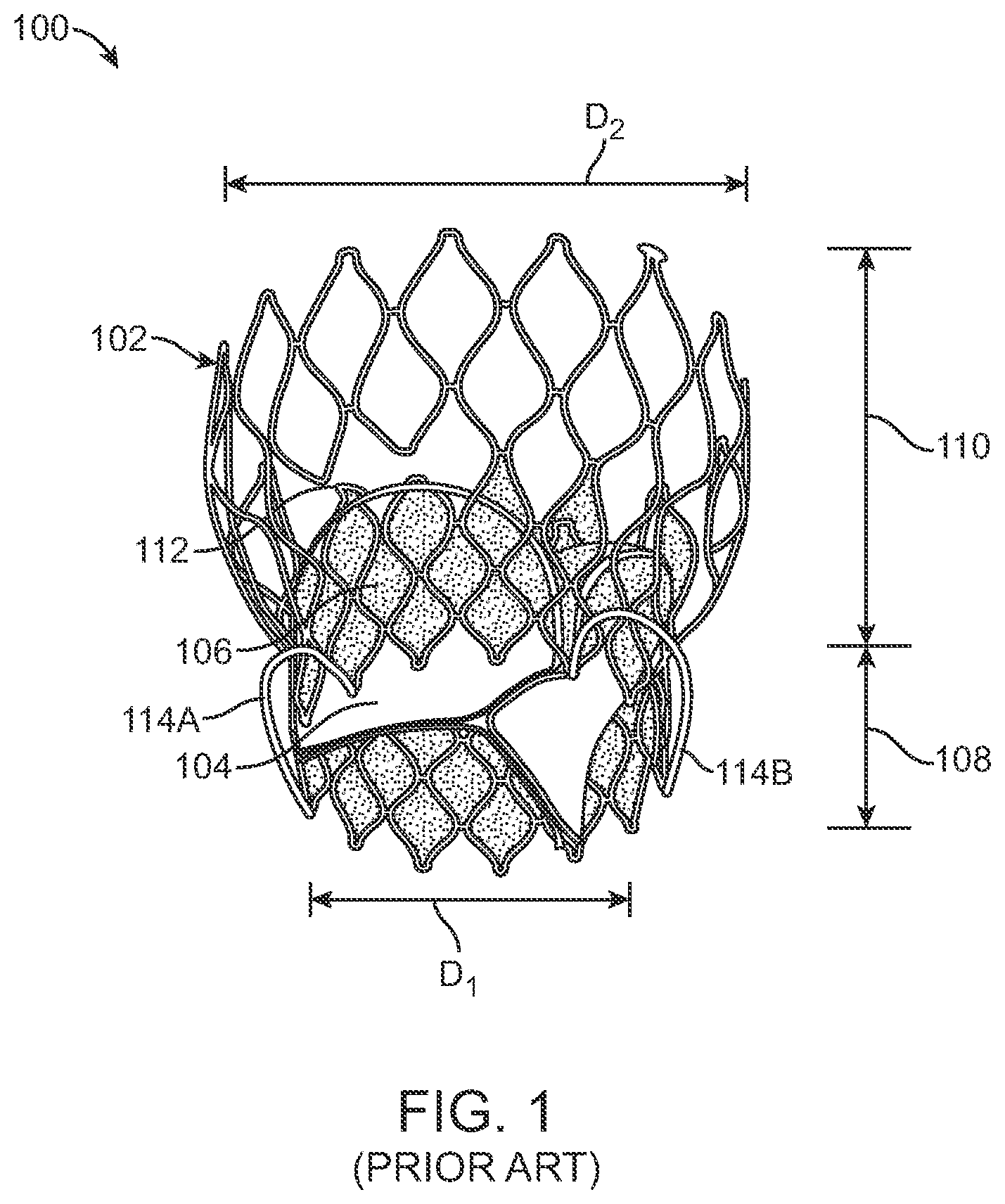 Patent US12569340 — Transcatheter valve prosthesis and a concurrently delivered sealing component — Figure 1
