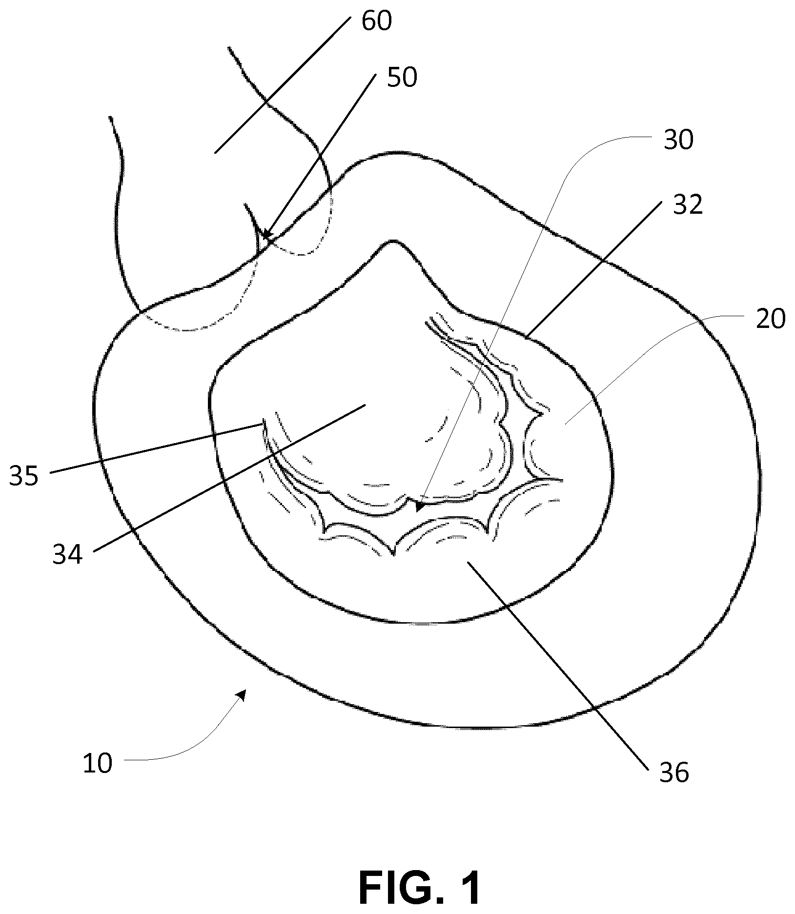 Patent US12569342 — Apparatus and methods for clamping a mitral valve — Figure 1