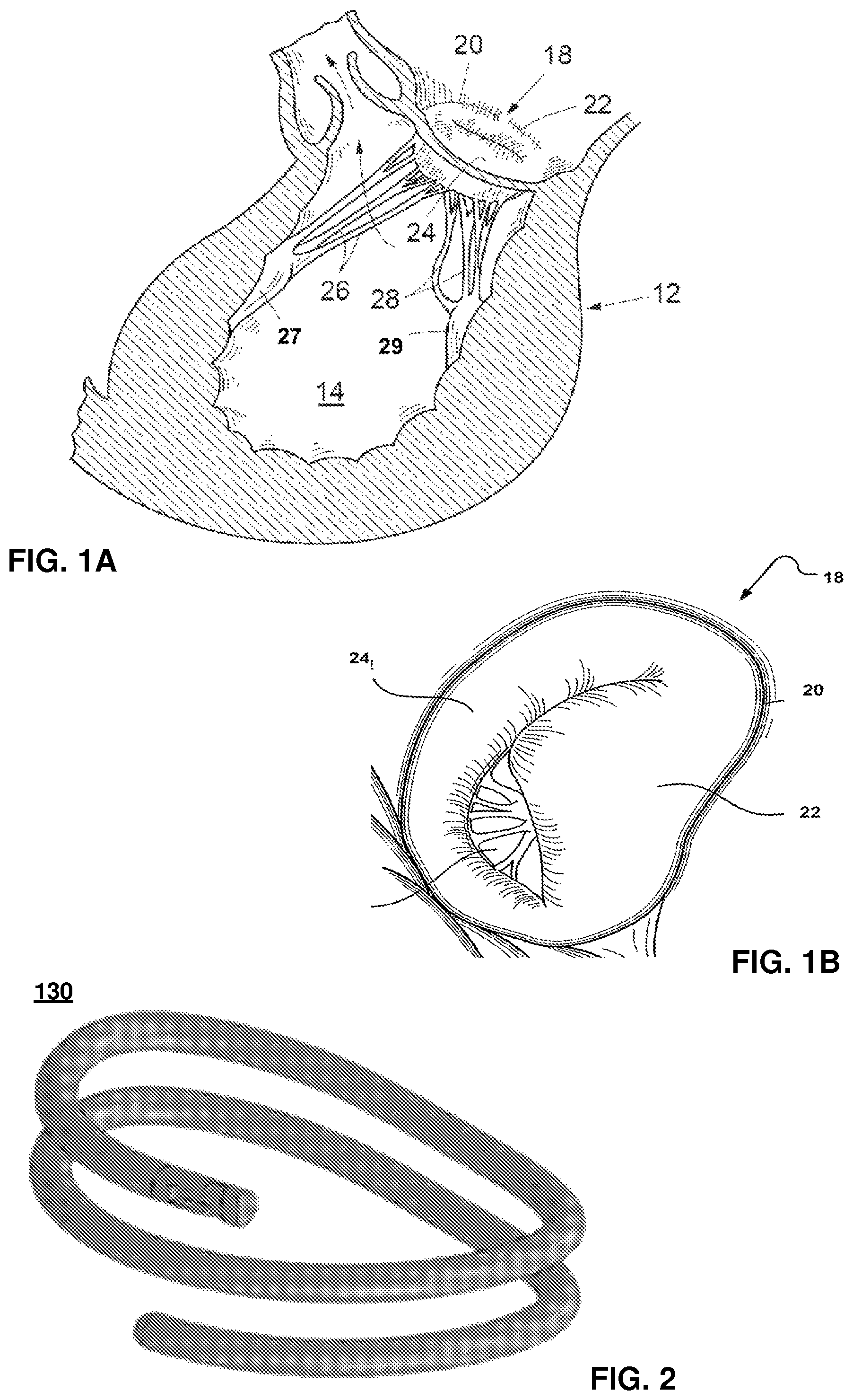 Patent US12569343 — Catheter for manipulating anatomical structure and relative position of the catheter and the anatomical structure — Figure 1