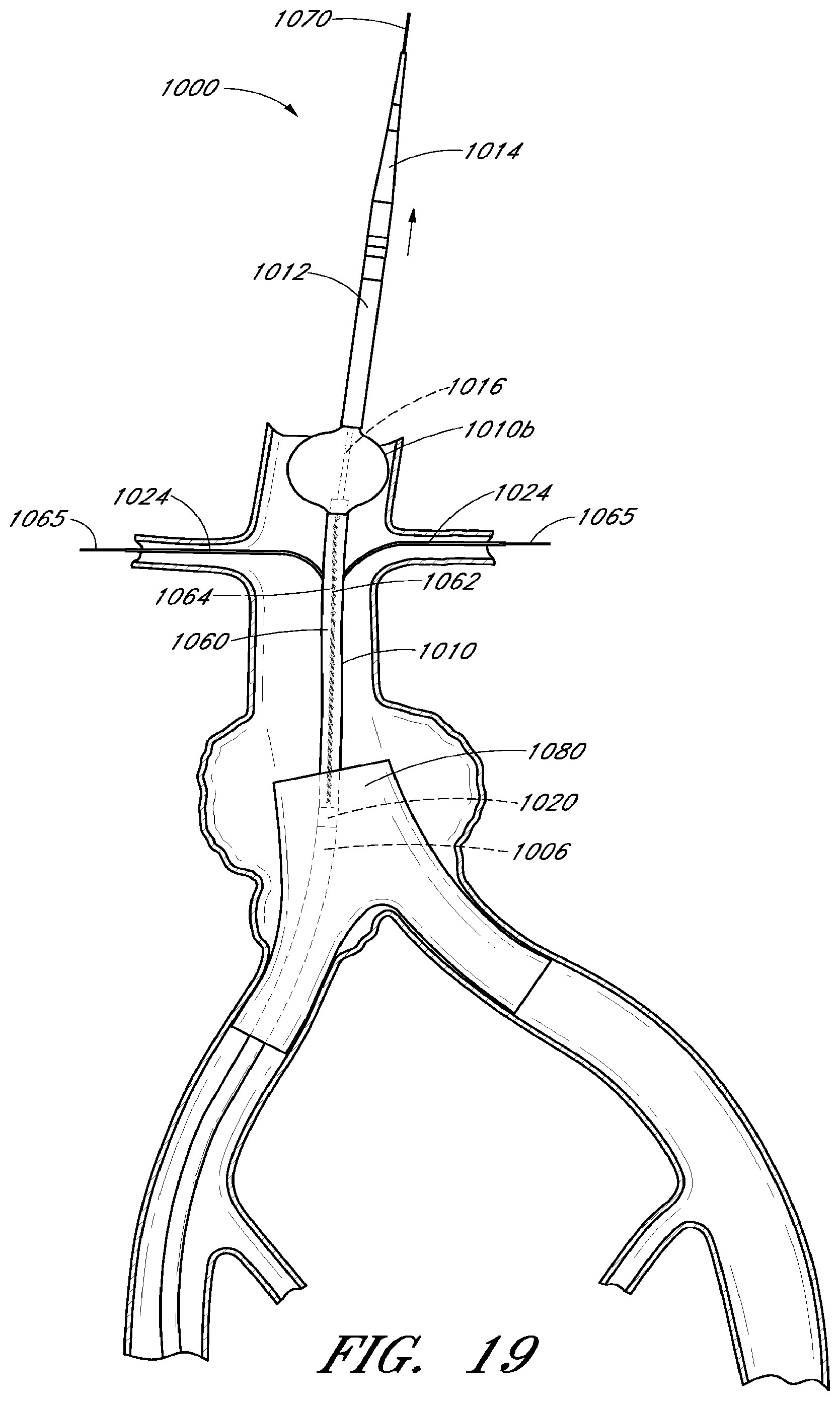 Patent US12569360 Figure 16 – Apparatus and method of placement of a graft or graft system