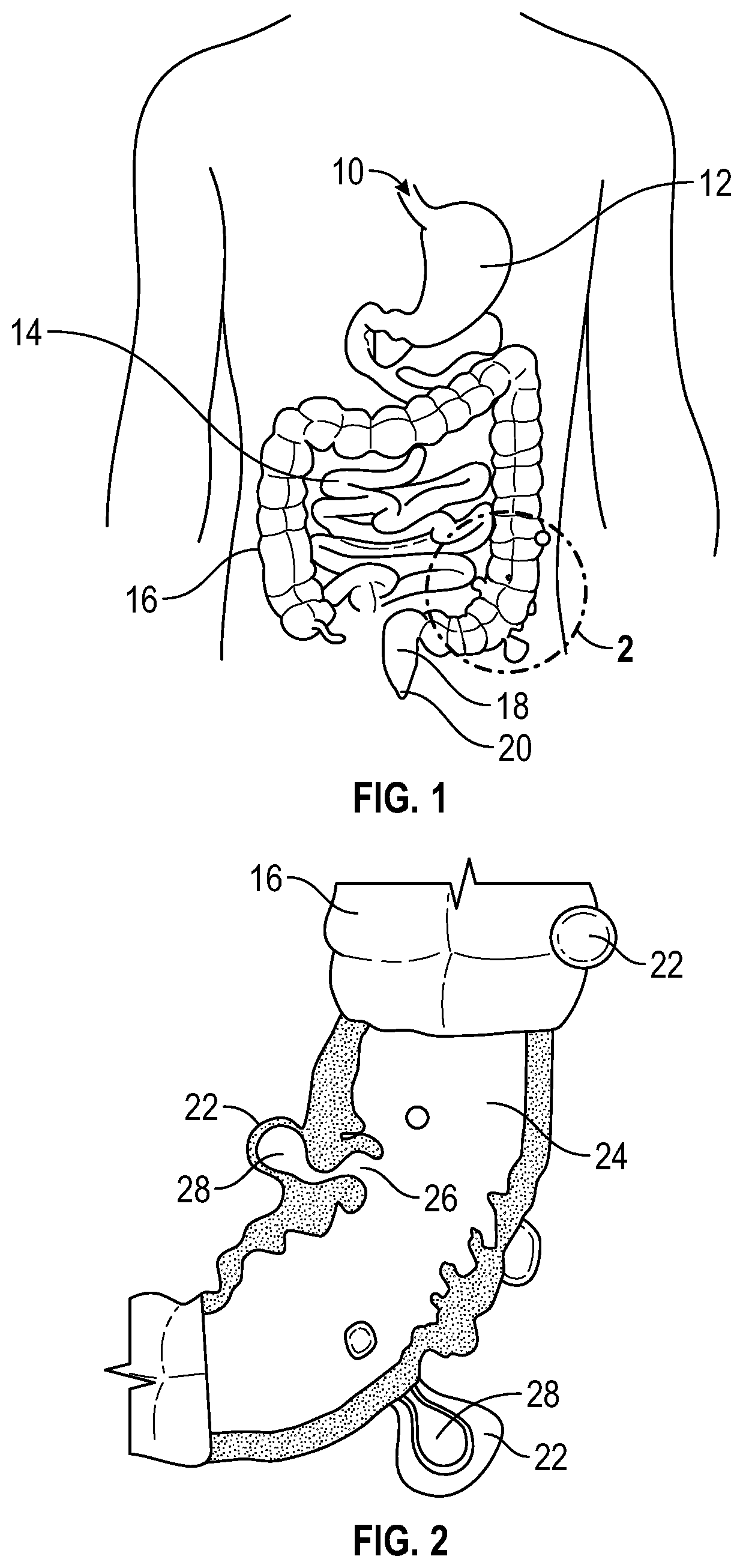 Patent US12569361 — Devices and methods to treat and prevent diverticulitis — Figure 1