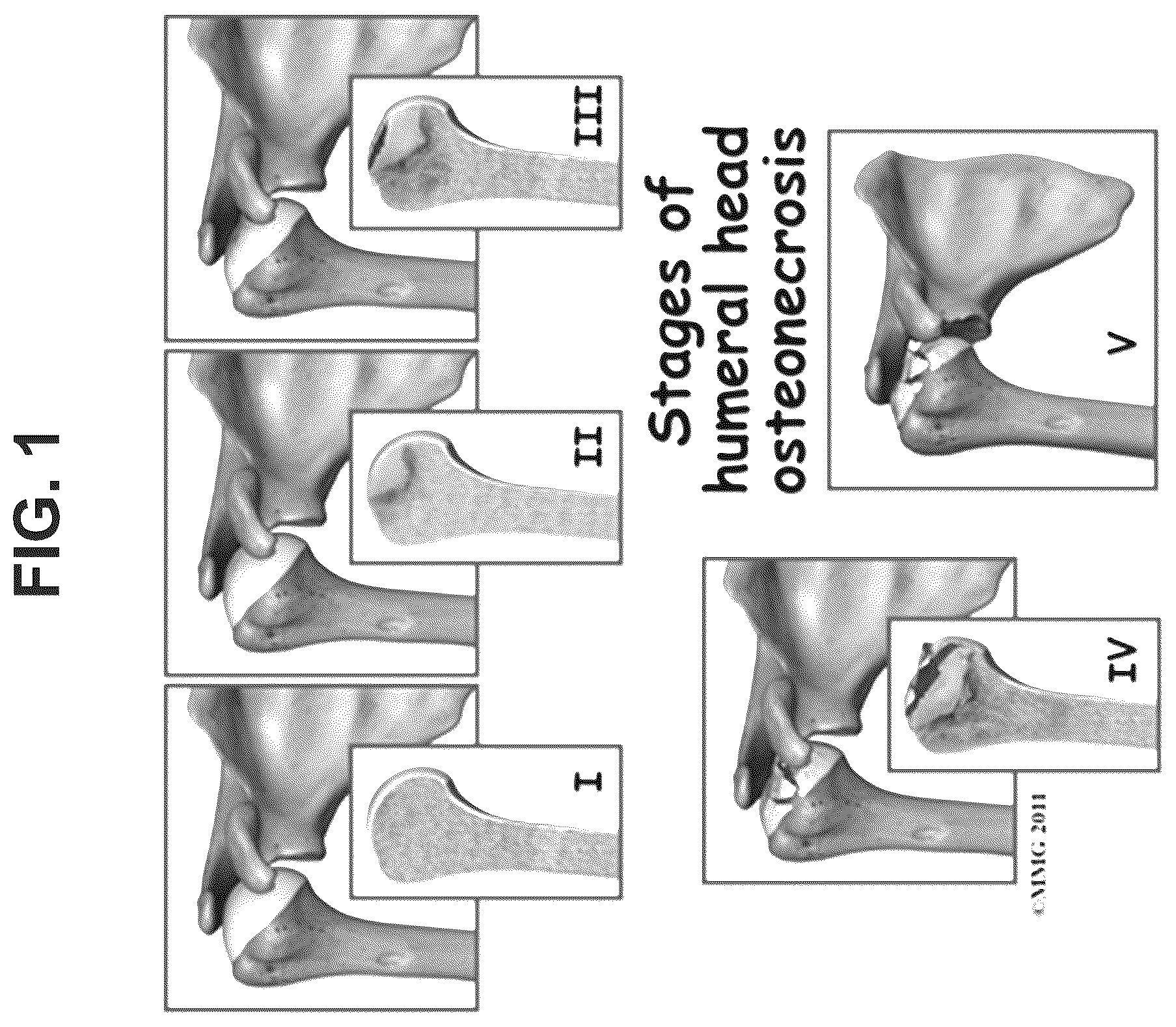 Patent US12569506 — Methods of treating osteonecrosis with LLP2A-bisphosphonate compounds — Figure 1