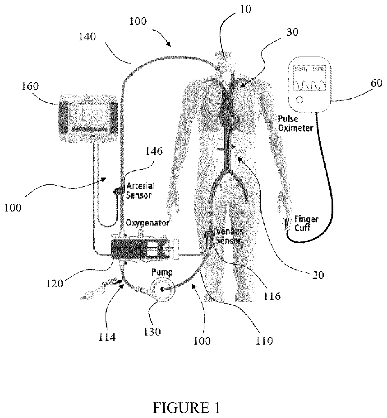 Patent US12569600 — Method and apparatus for assessing cardiac output in veno-venous extracorporeal blood oxygenation — Figure 1