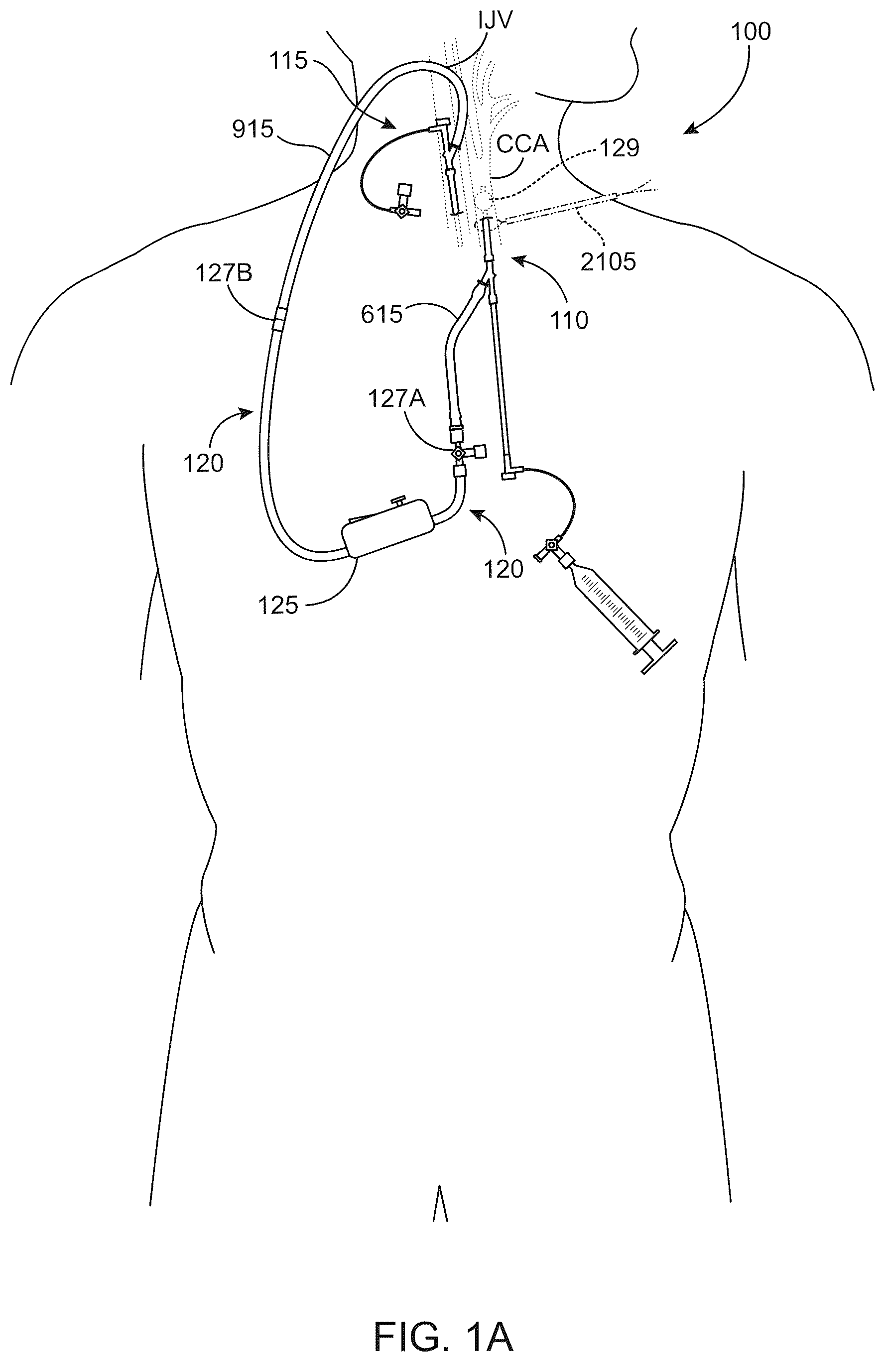 Patent US12569607 Figure 1 – Embolic protection in connection with transcarotid carotid artery revascularization