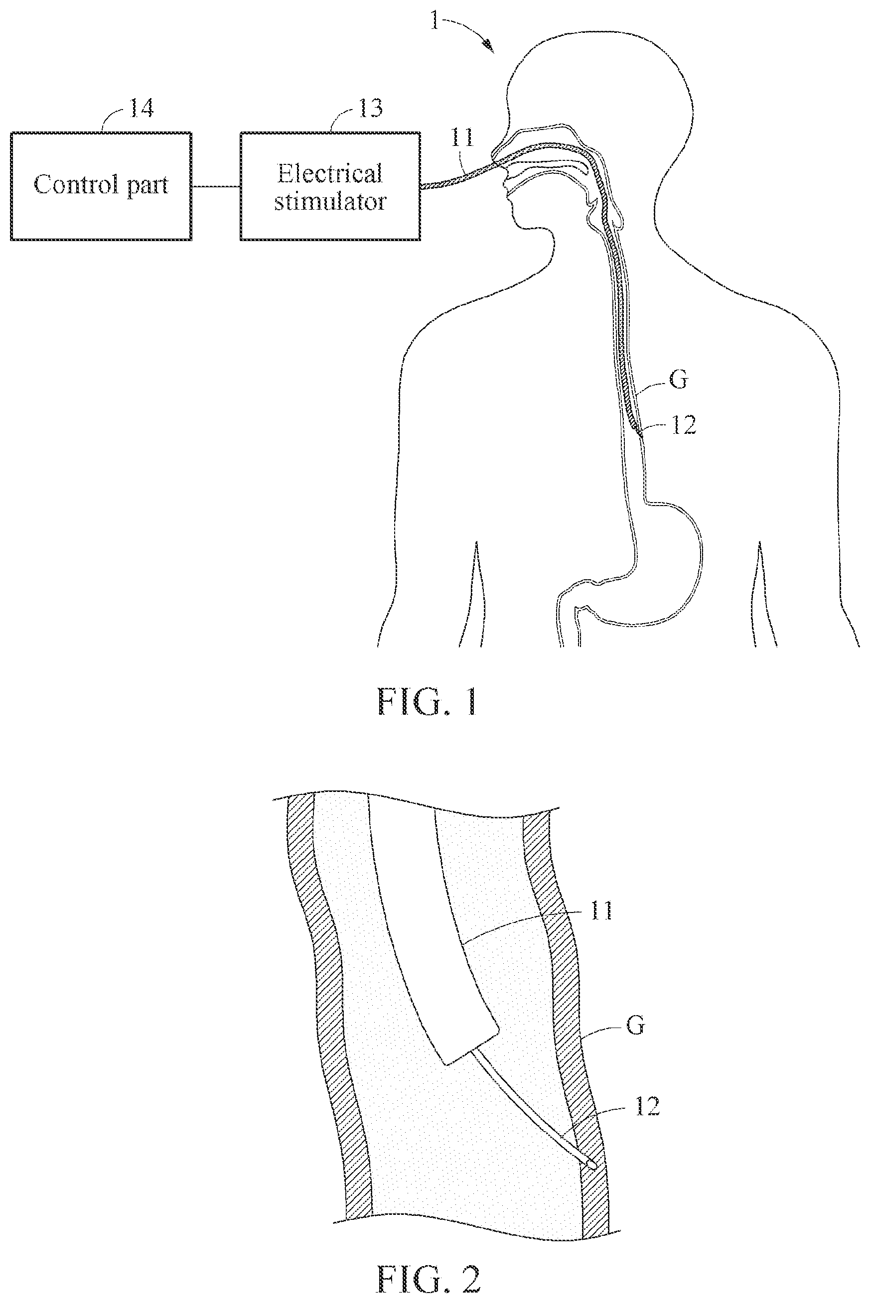 Patent US12569674 — Electrical stimulation system — Figure 1