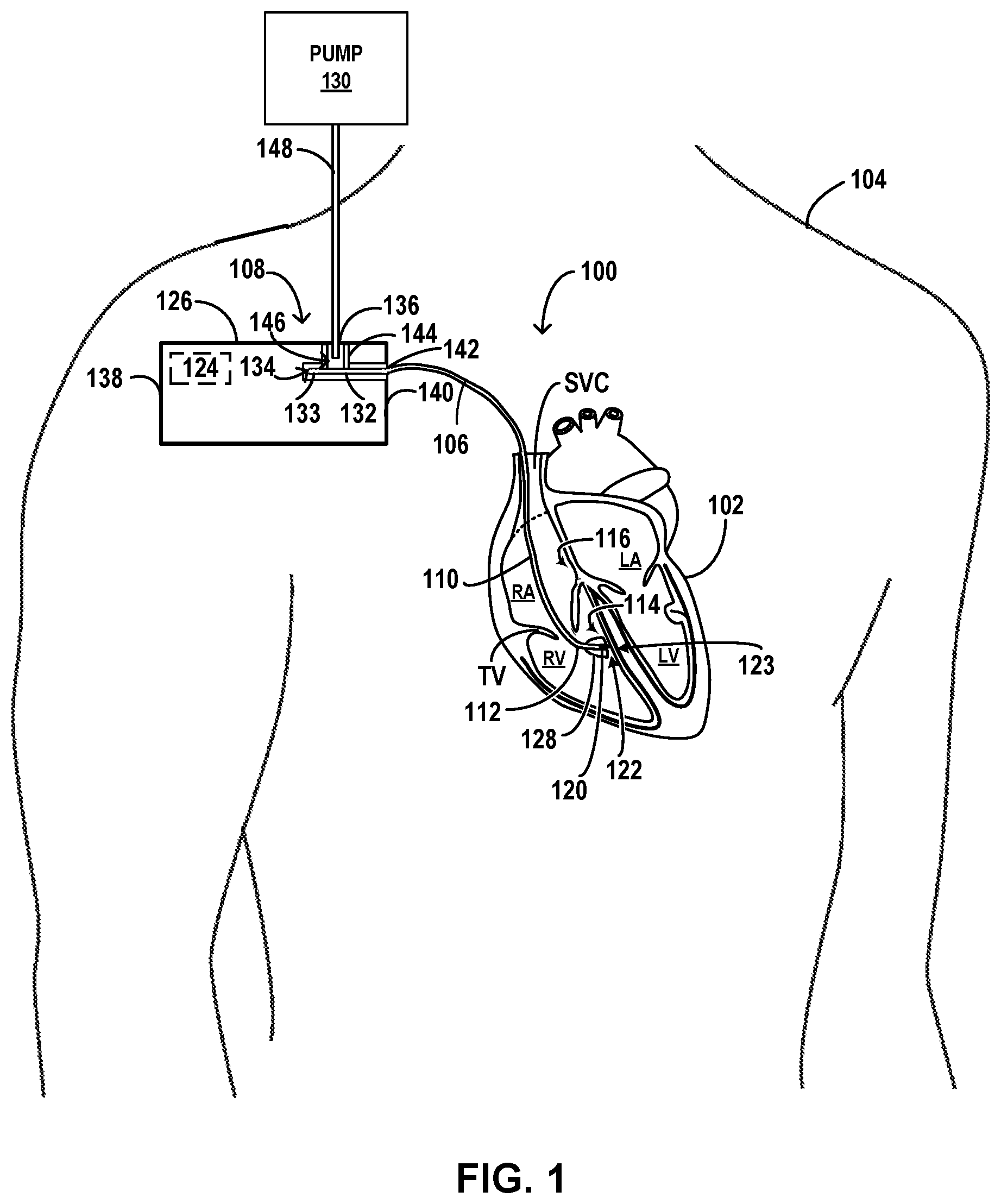 Patent US12569676 — Implantable medical system — Figure 1