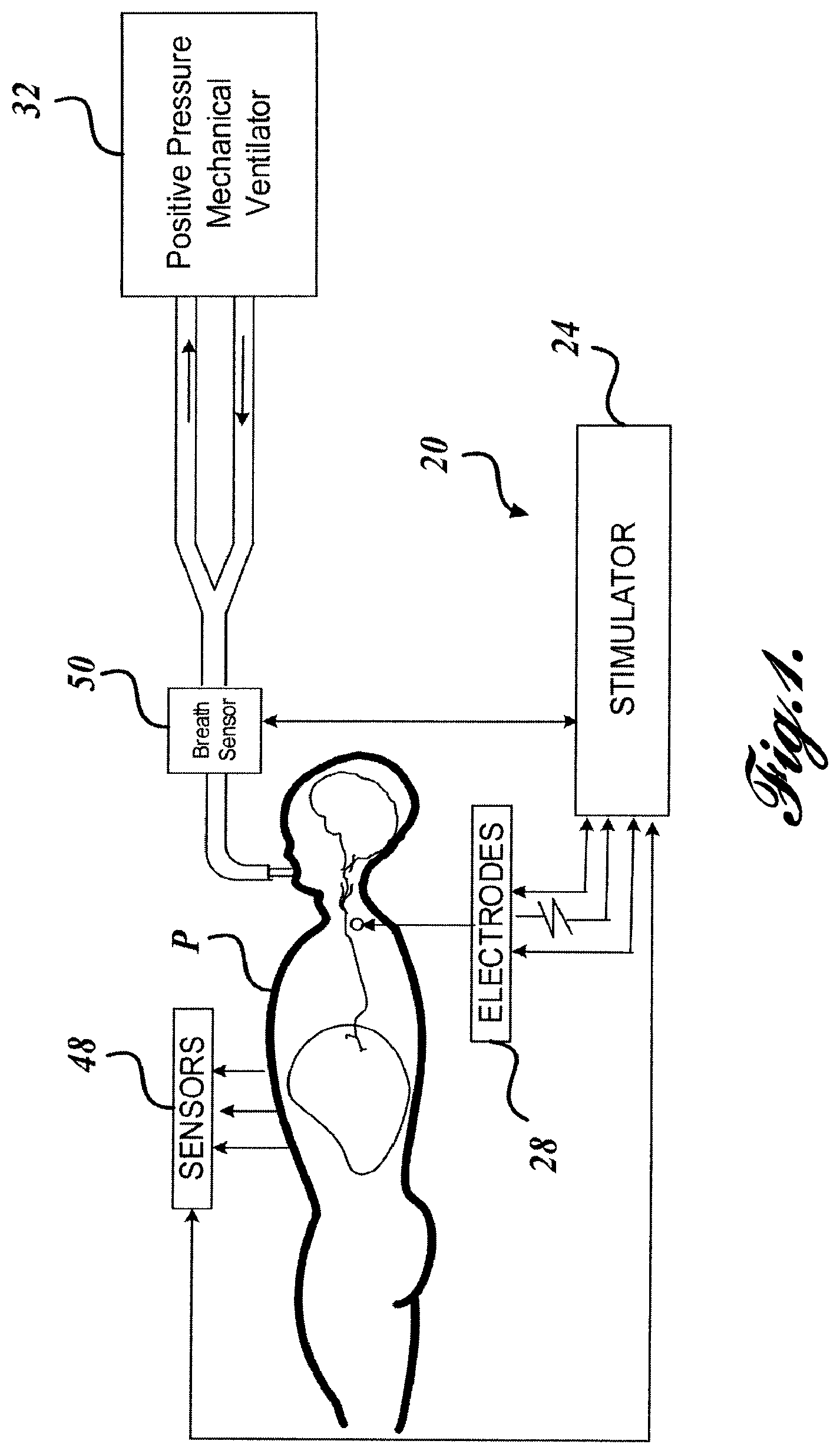 Patent US12569681 — Transvascular diaphragm pacing systems and methods of use — Figure 1