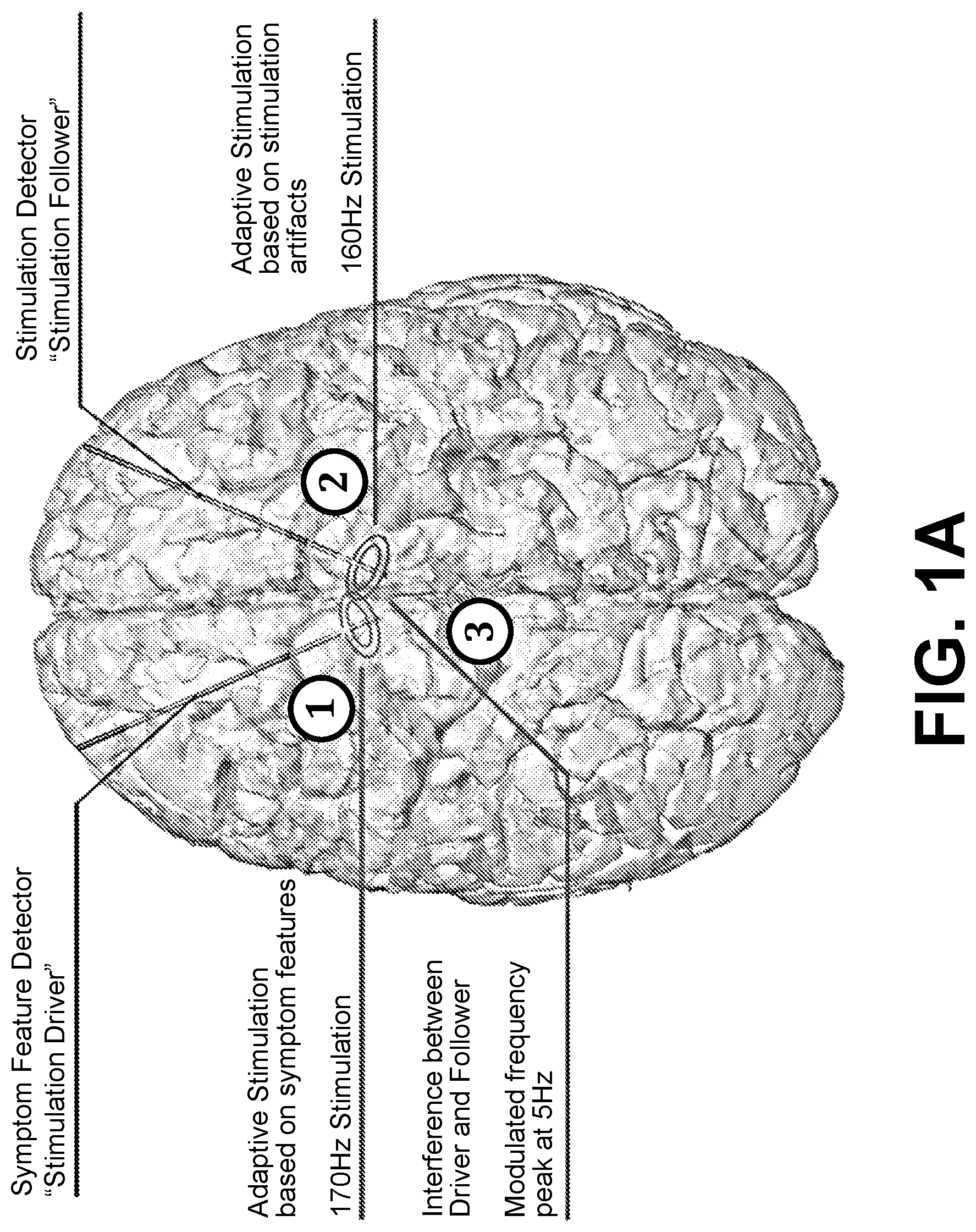 Patent US12569685 — Simultaneous bilateral stimulation using neurostimulator — Figure 1
