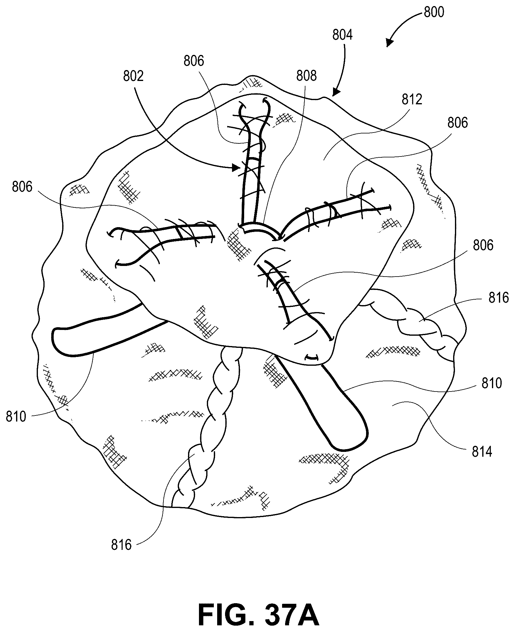 Patent US12569691 Figure 19 – Atrial appendage occlusion and arrhythmia tratment