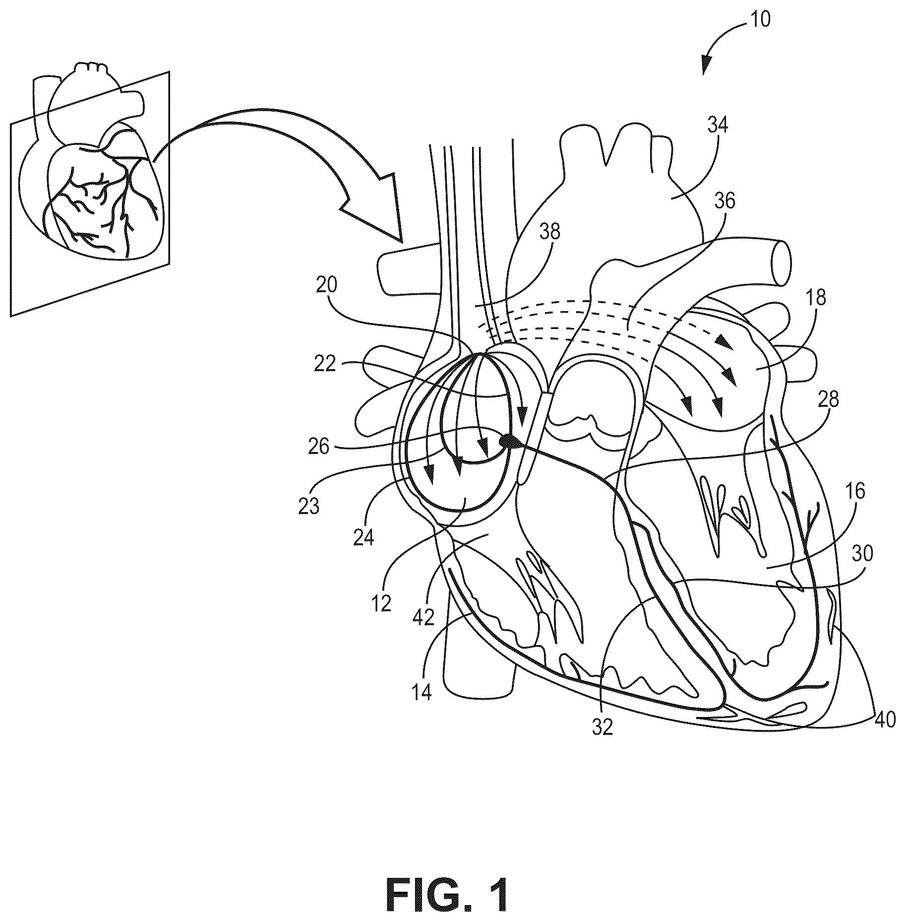 Patent US12569694 — Adjustable lead systems for cardiac septal wall implantation — Figure 1
