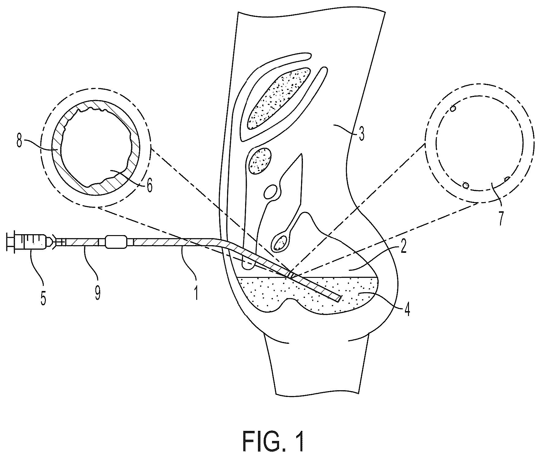 Patent US12569892 — Methods and compositions for decontaminating PD catheters — Figure 1