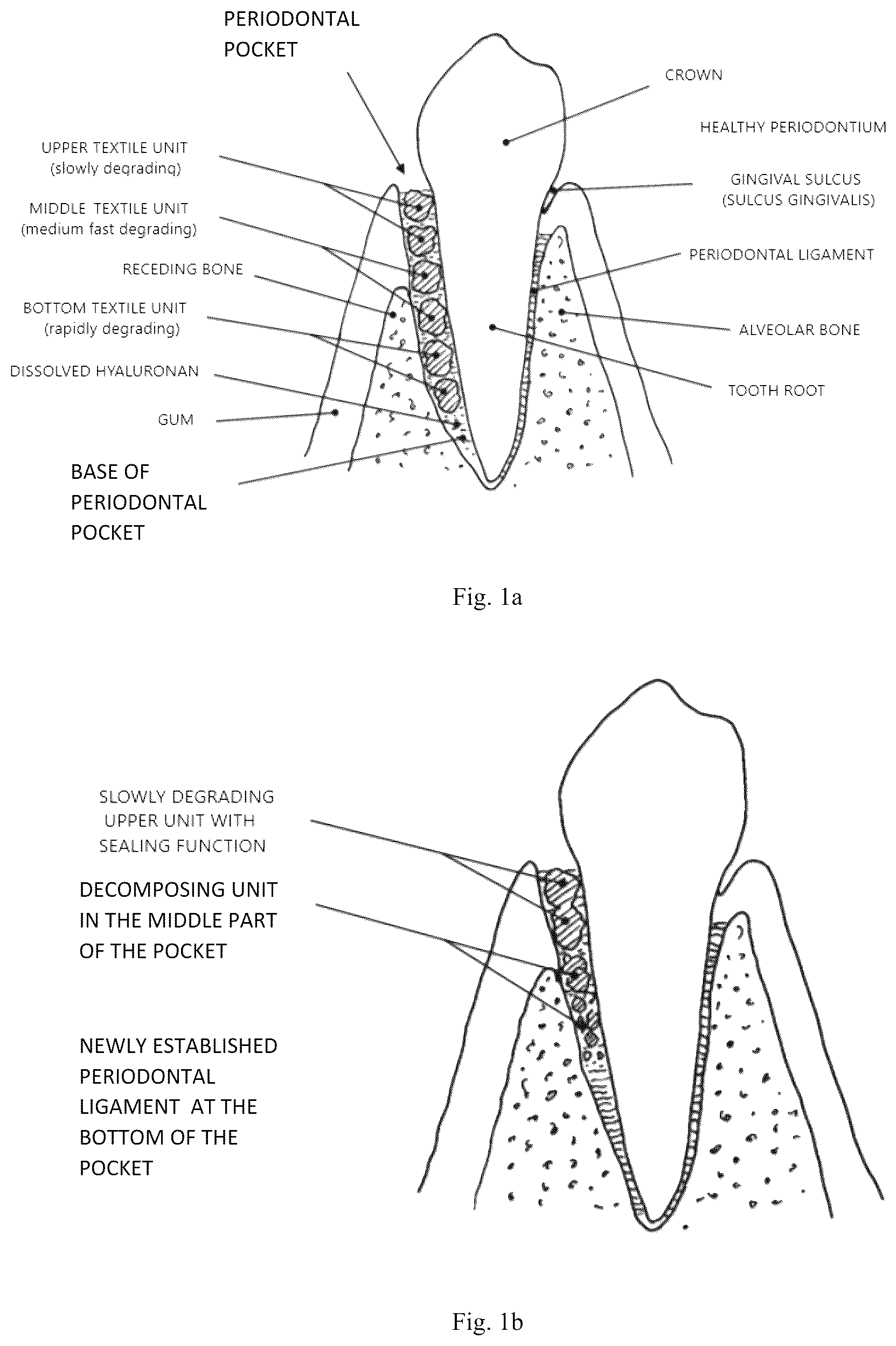 Patent US12576104 Figure 1 – Dental preparation comprising fibers based on hyaluronic acid with regulated biodegradability