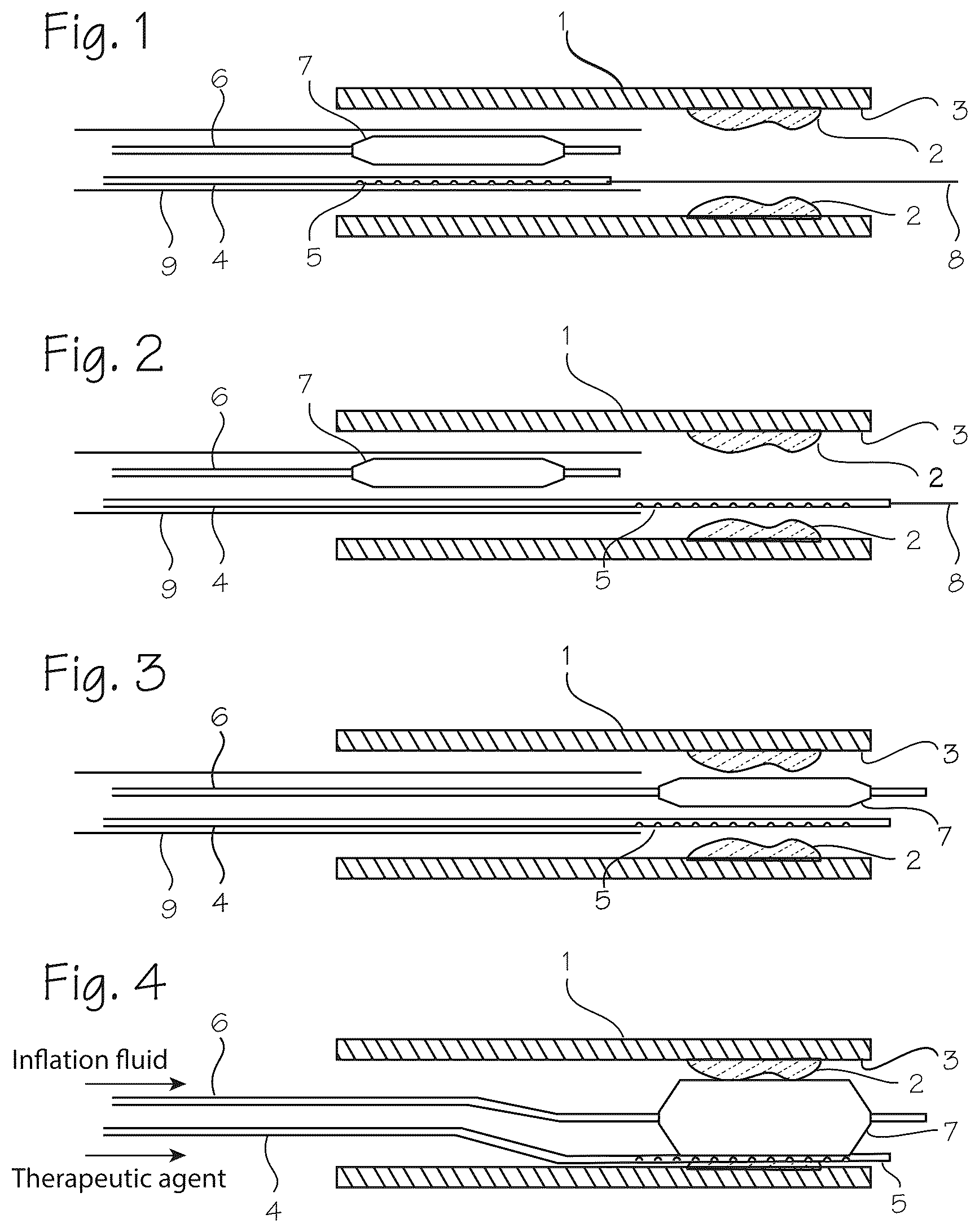 Patent US12576249 — Infusion catheter and balloon catheter system and method — Figure 1