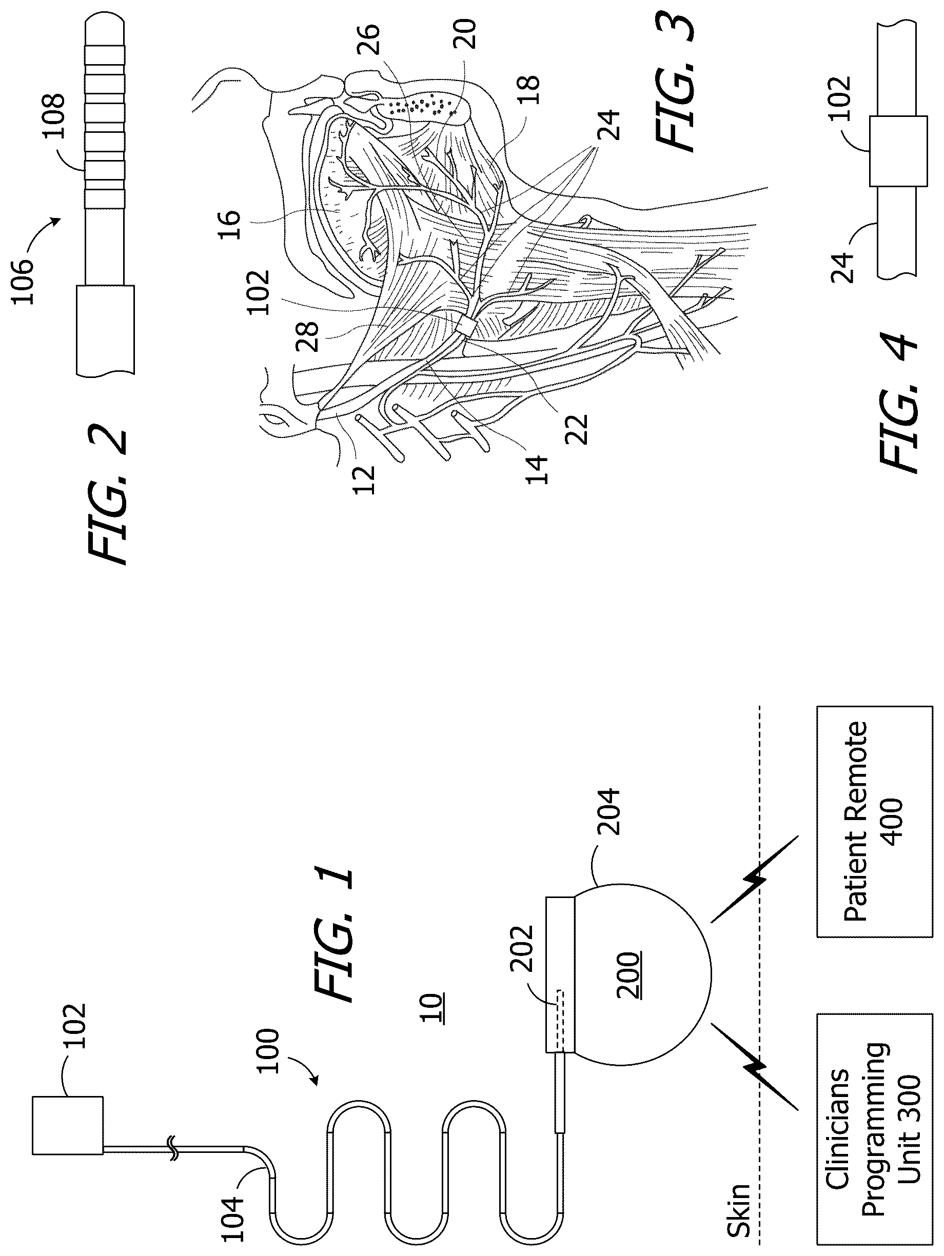 Patent US12576267 — Tissue stimulation apparatus and methods of making the same — Figure 1