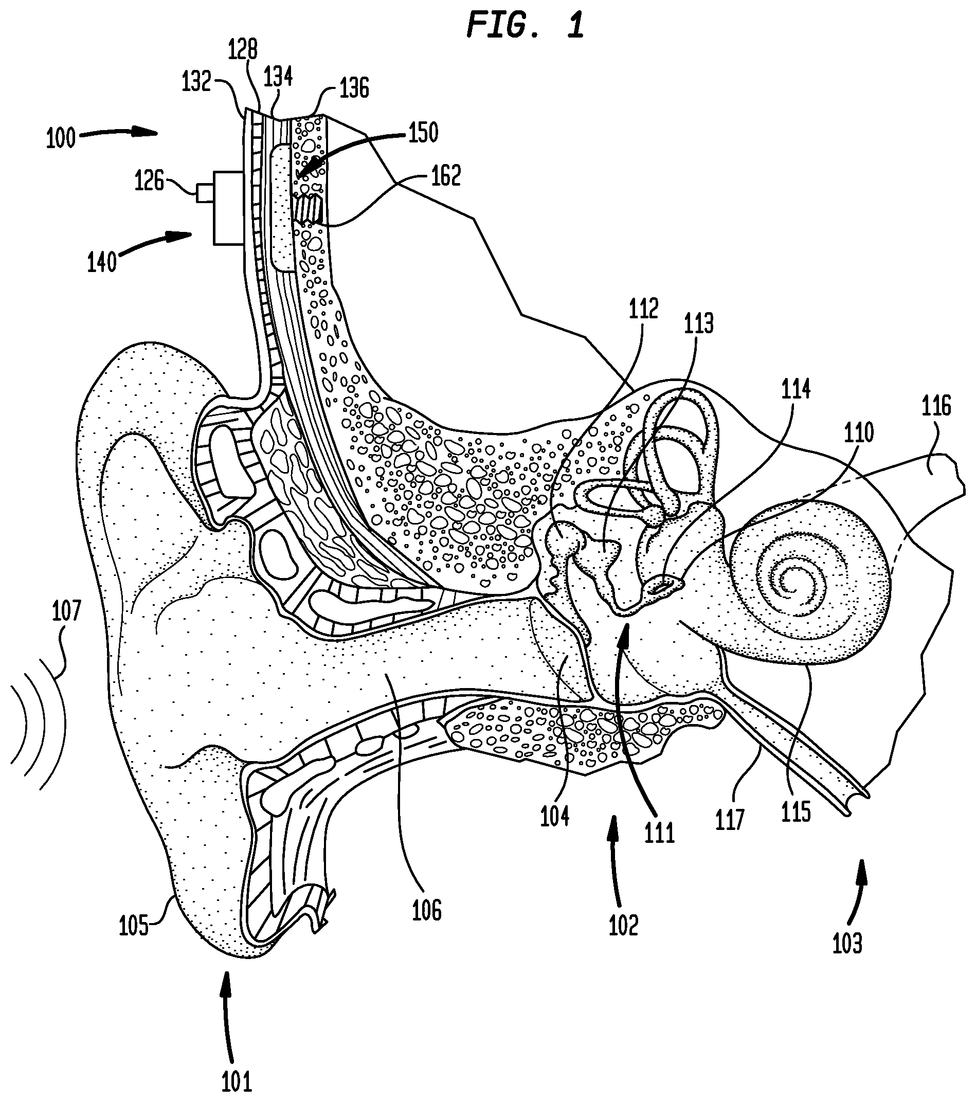 Patent US12581254 — Convertibility of a bone conduction device — Figure 1