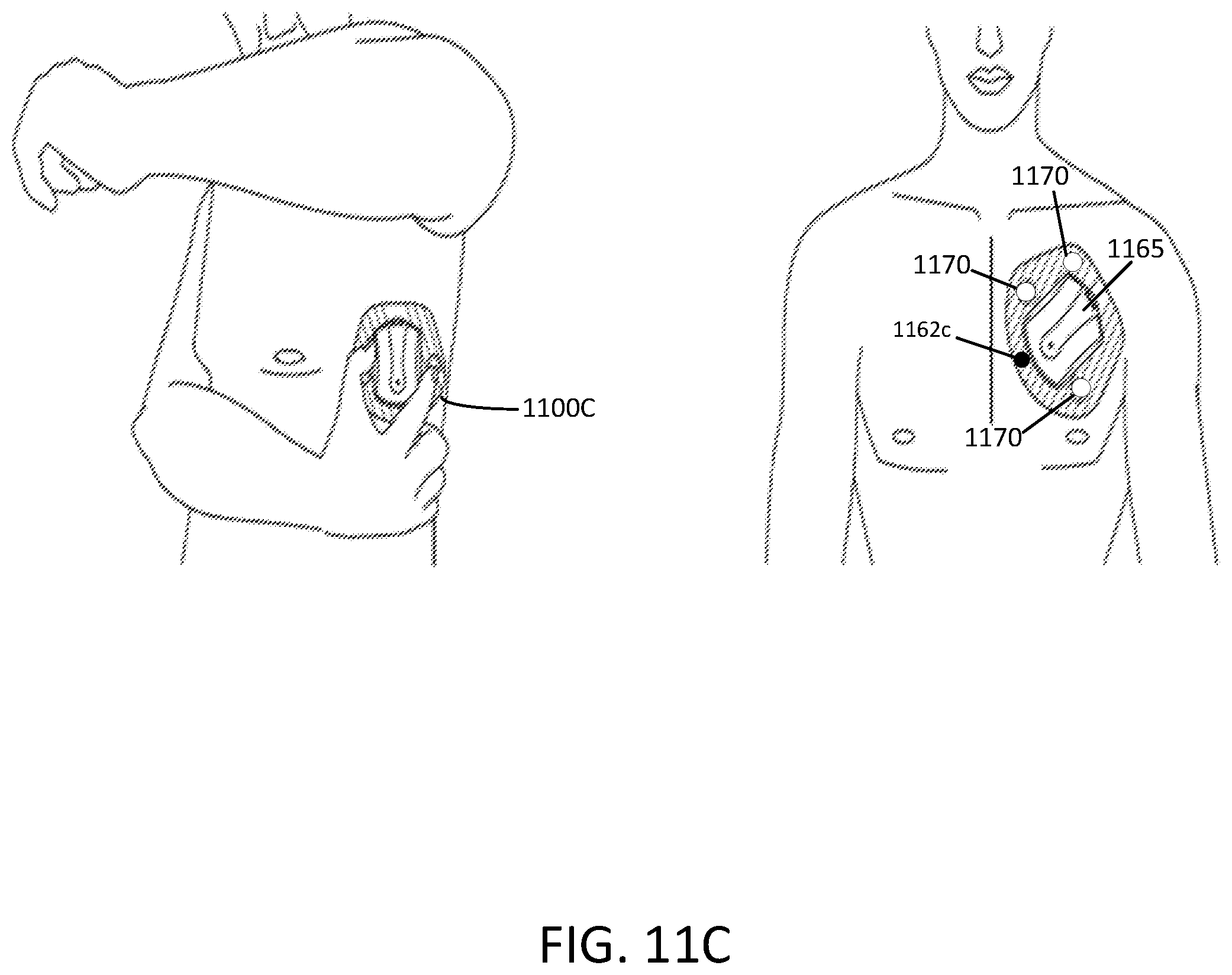 Patent US12588827 Figure 17 – Determining different sleep stages in a wearable medical device patient