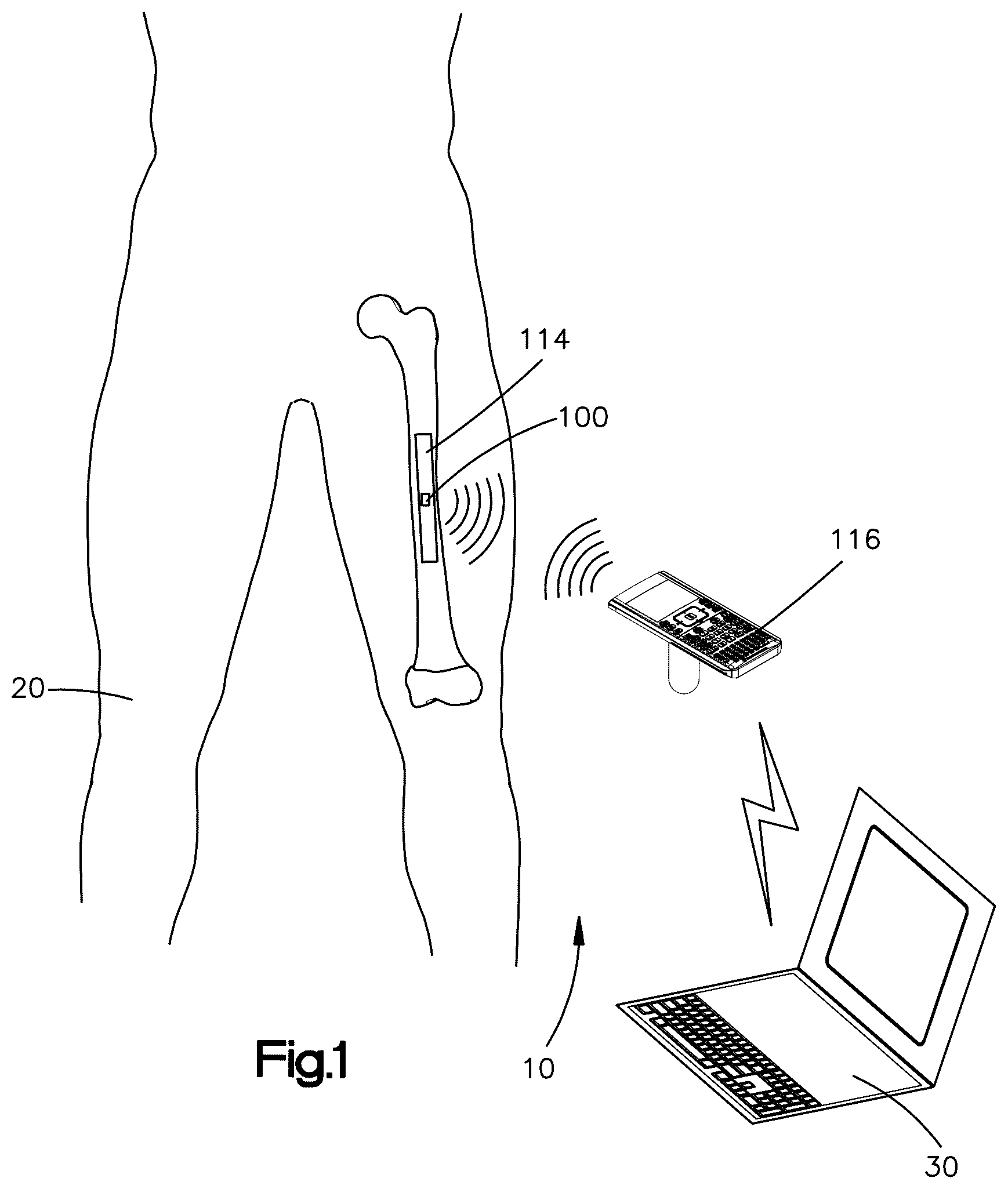 Patent US12588864 — Sensors implantable into a patient's body, systems, and methods of using the same — Figure 1