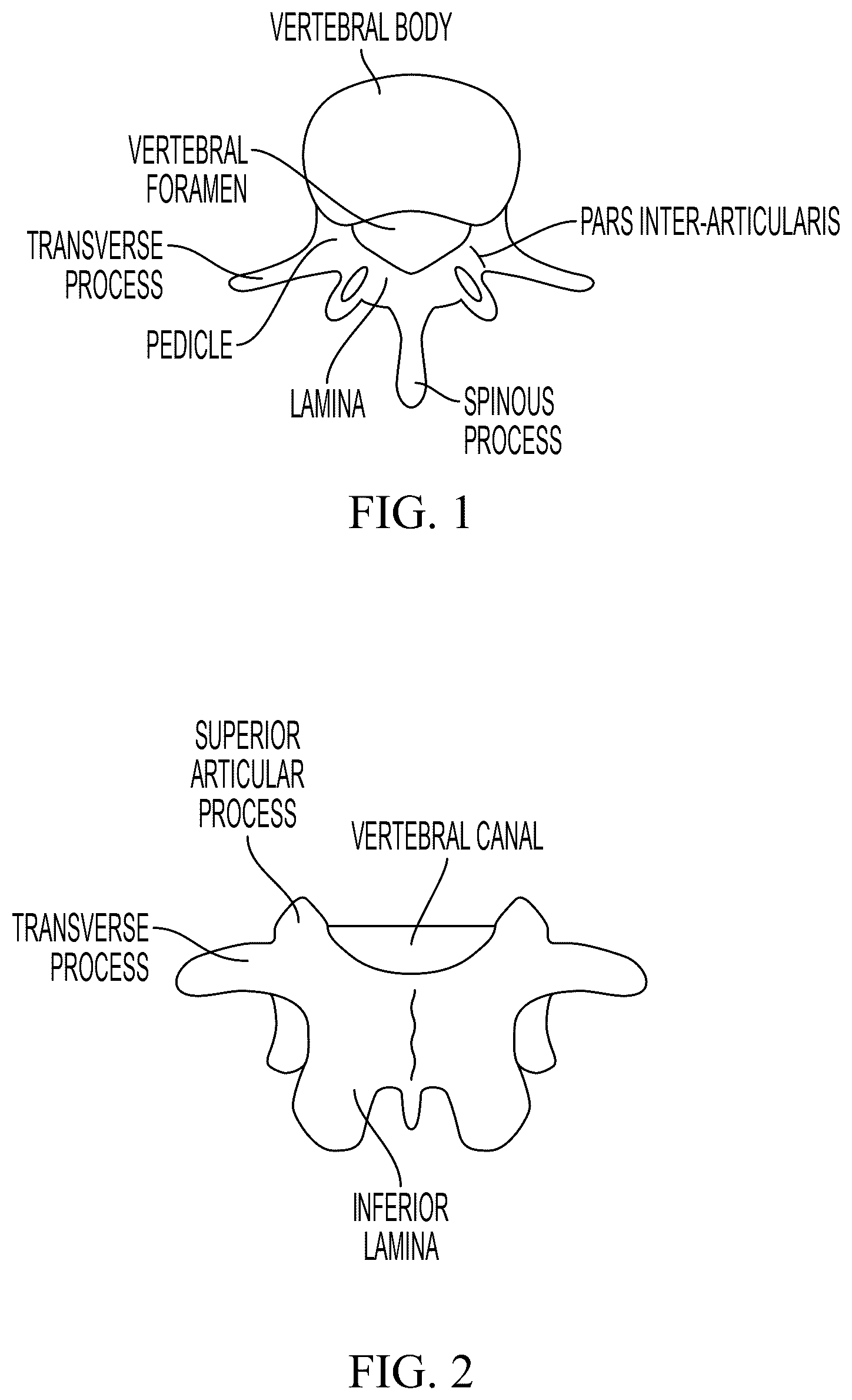 Patent US12588934 — Lumbar spondylolysis fracture fixation system — Figure 1