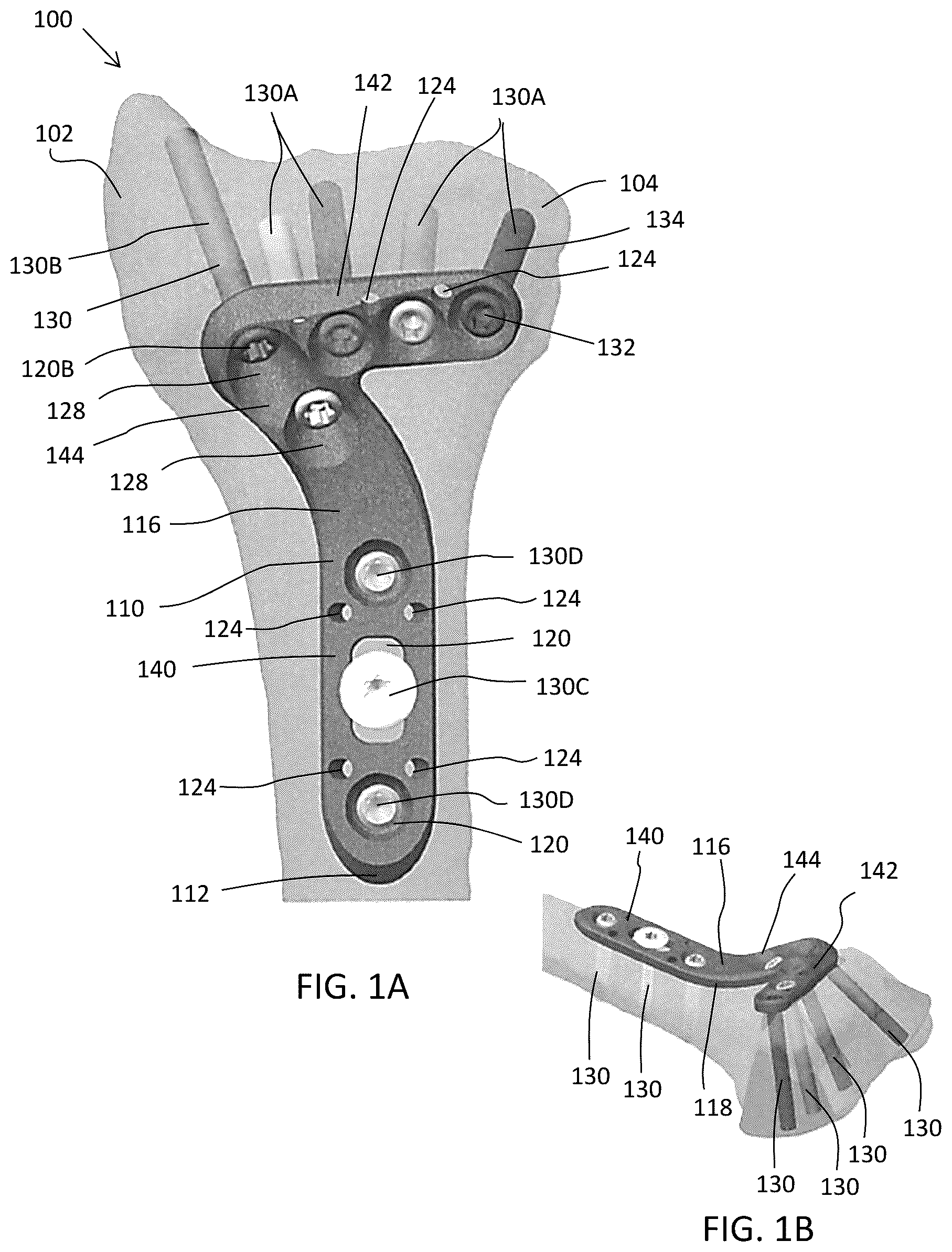 Patent US12588937 — Volar distal radius stabilization system — Figure 1