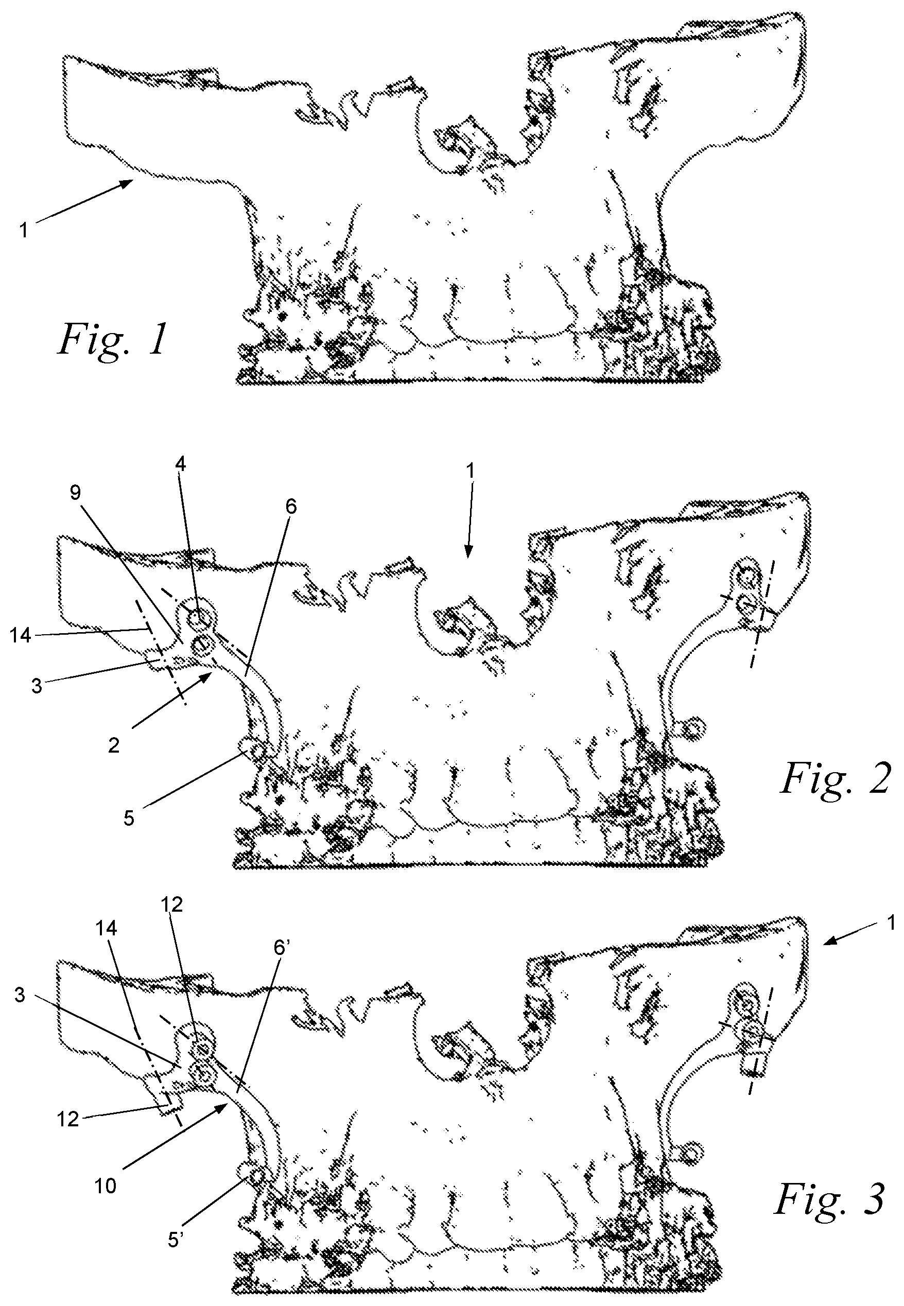 Patent US12588969 — Bone anchor for an upper or lower jaw with a corresponding drilling template — Figure 1