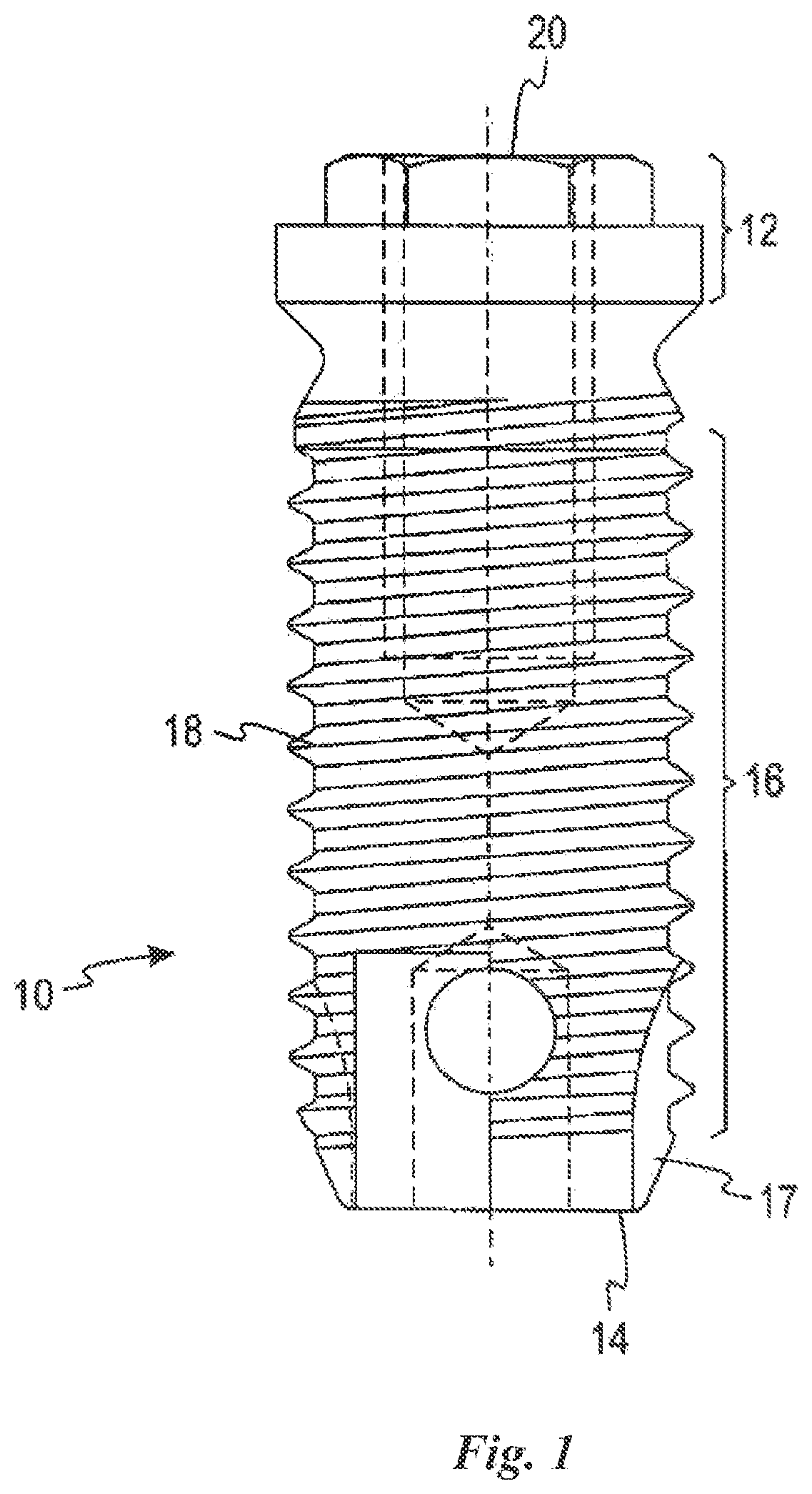 Patent US12588981 — Surface treatment for an implant surface — Figure 1