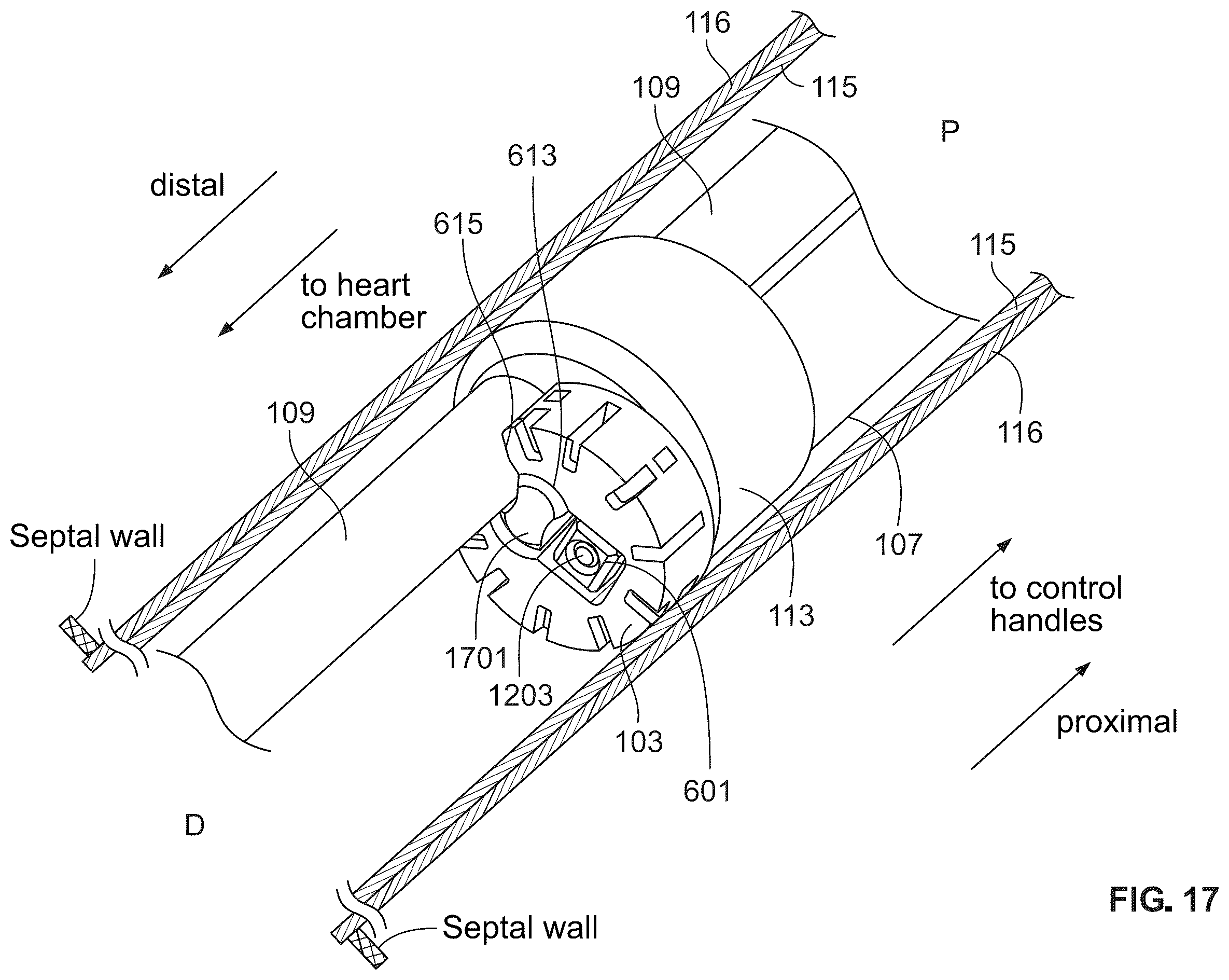 Patent US12588988 Figure 14 – Implant delivery
