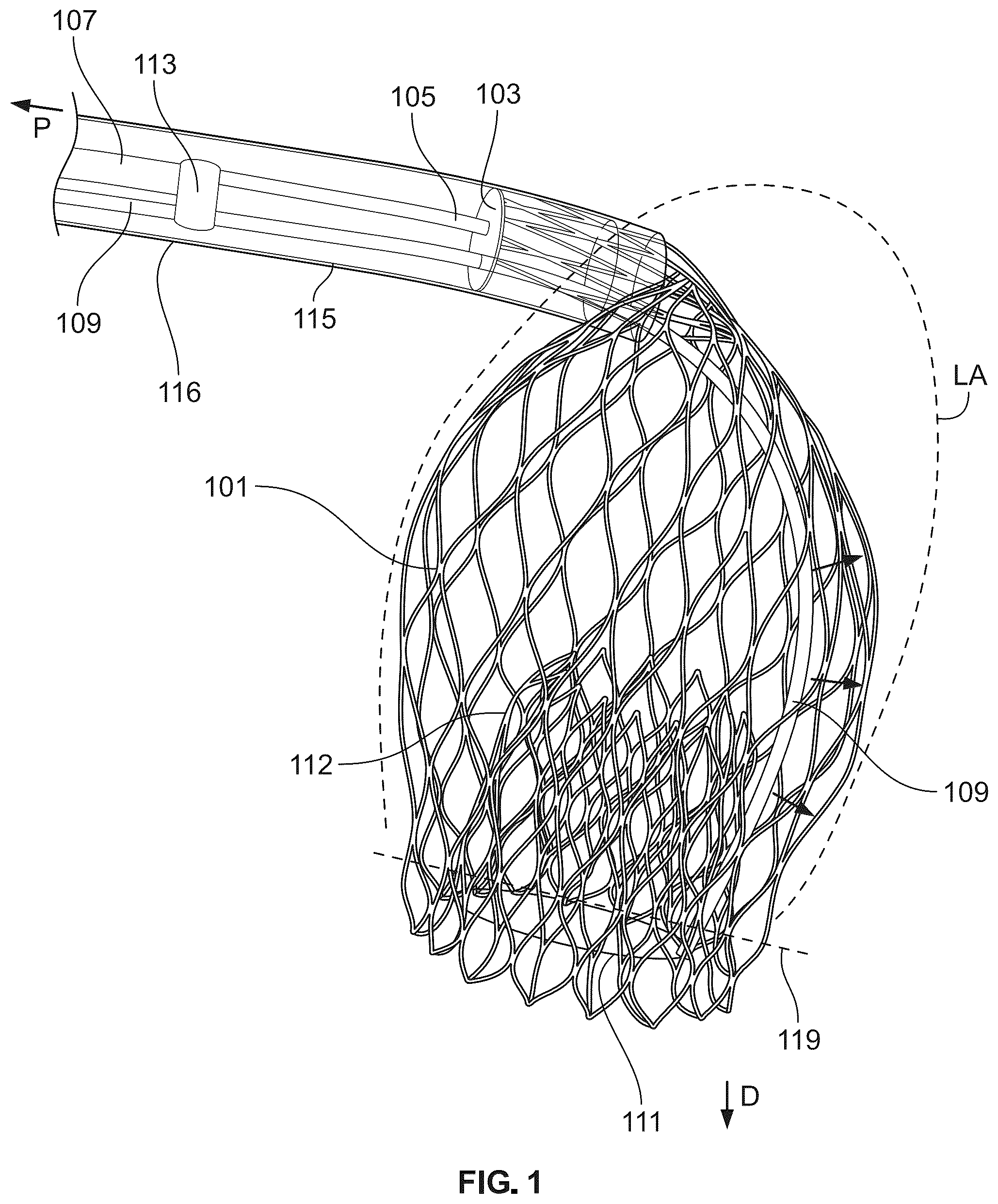Patent US12588989 Figure 1 – Implant delivery