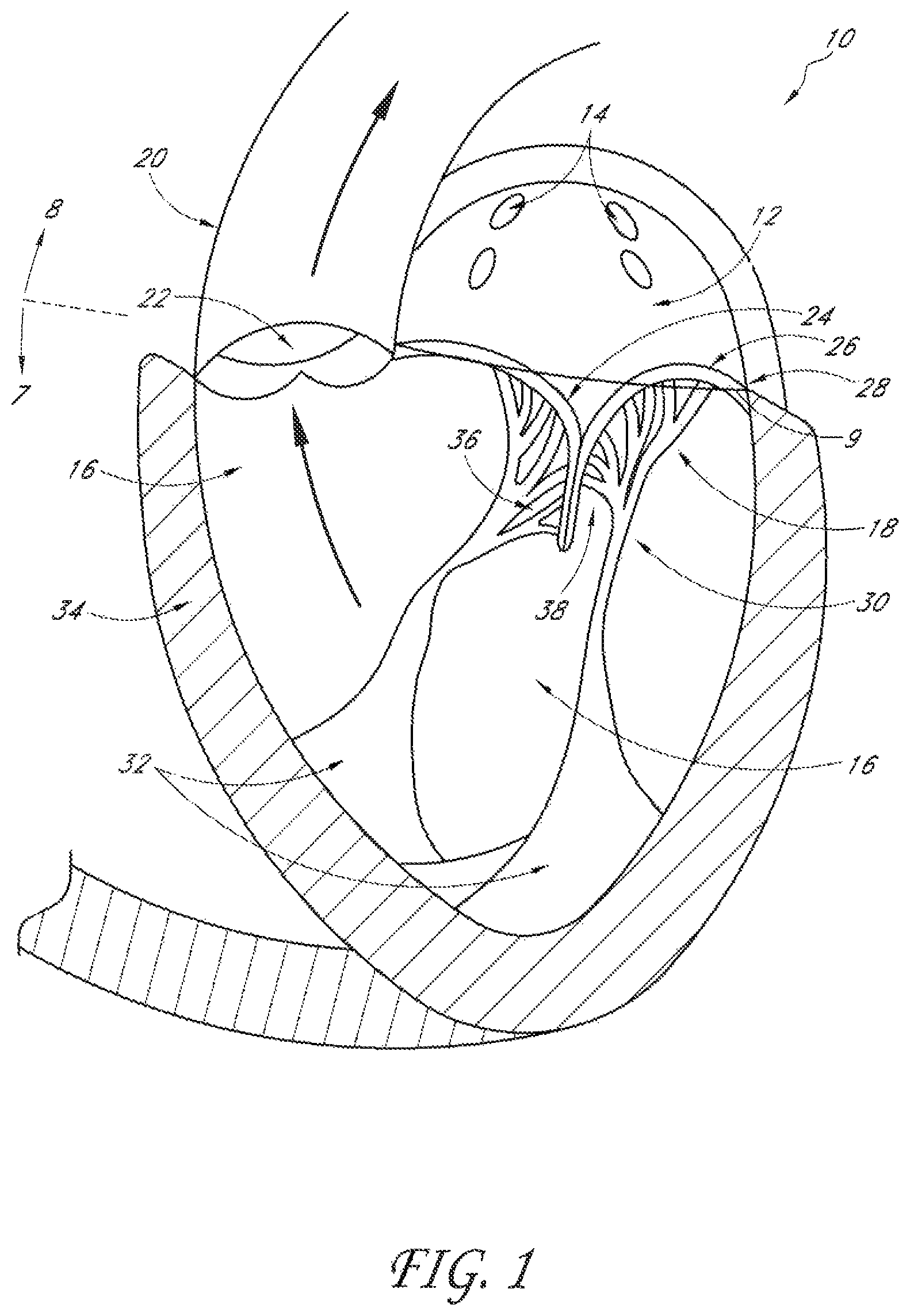 Patent US12588995 — Transvalvular intraanular band and chordae cutting for ischemic and dilated cardiomyopathy — Figure 1