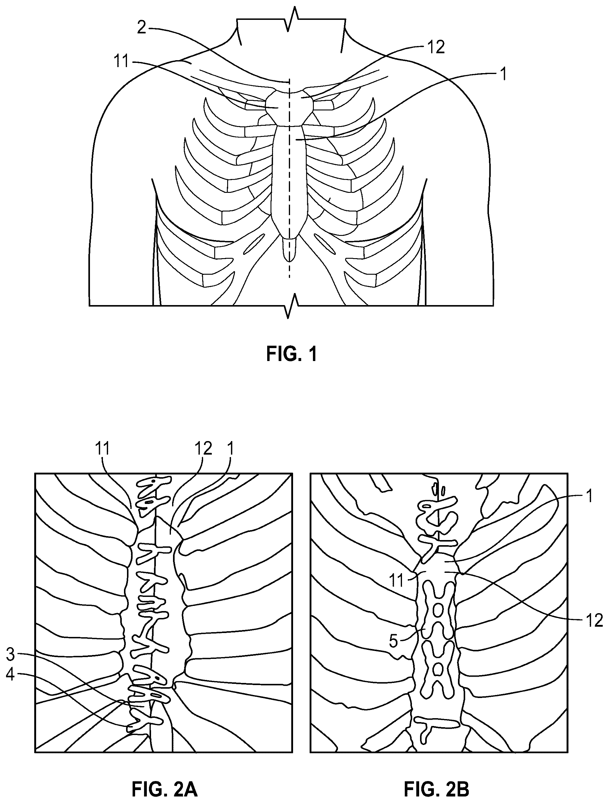 Patent US12588999 — System and method to fuse bone — Figure 1