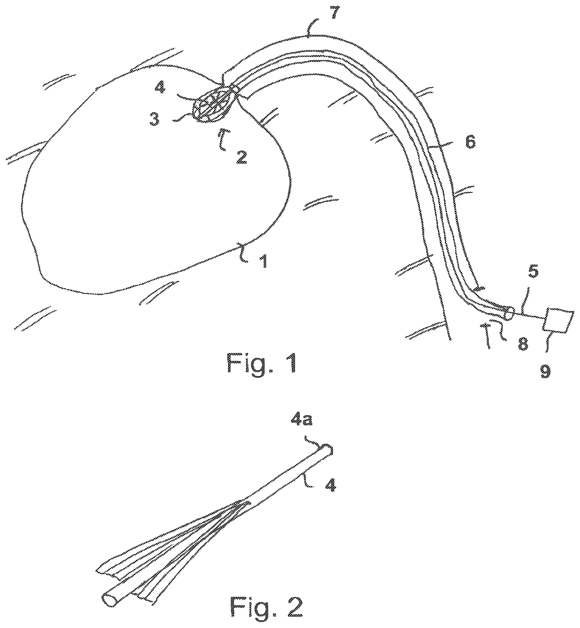Patent US12590589 Figure 1 – Radially compressible and expandable rotor for a fluid pump