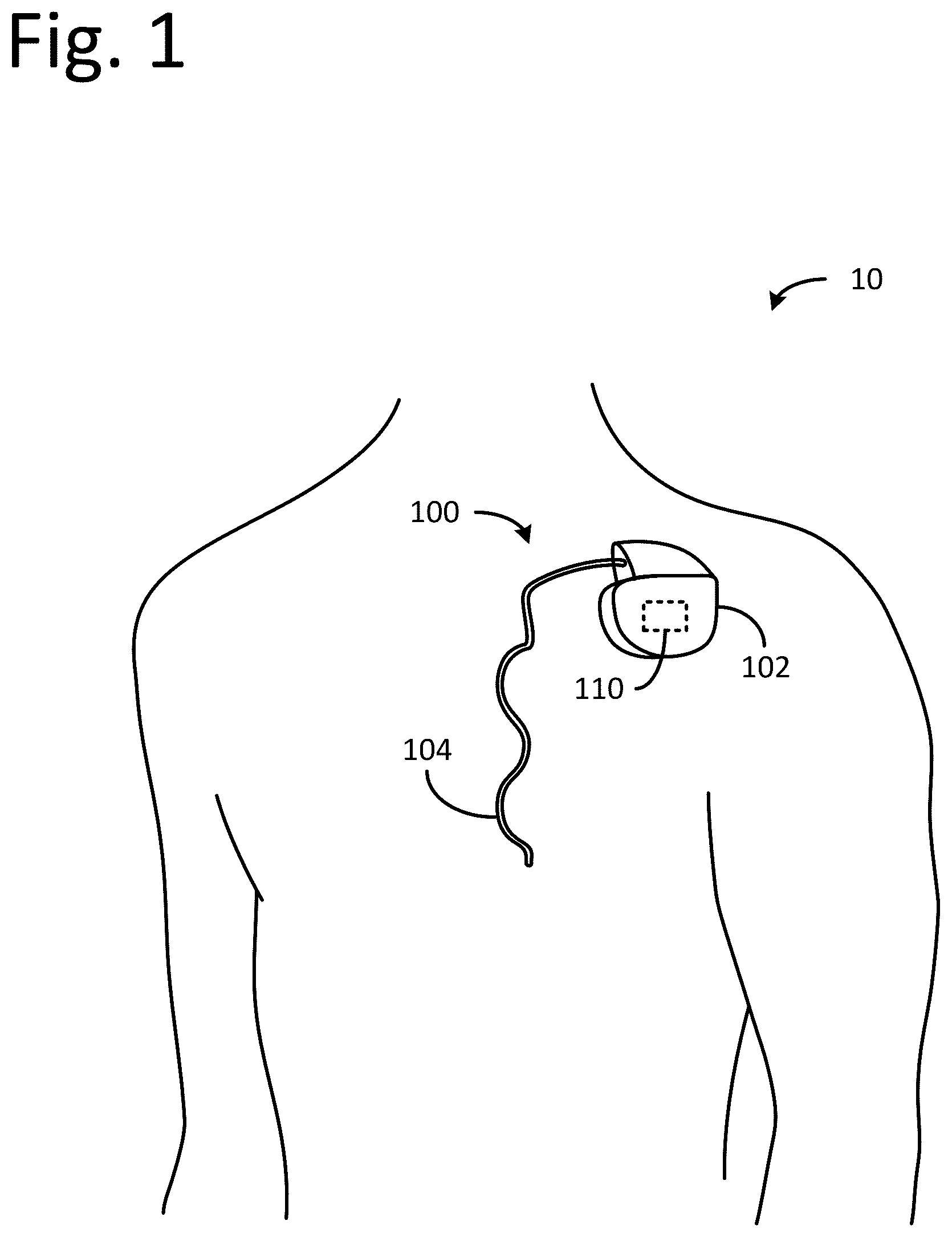 Patent US12592382 — Electrochemical cells with lithium alloy anodes — Figure 1