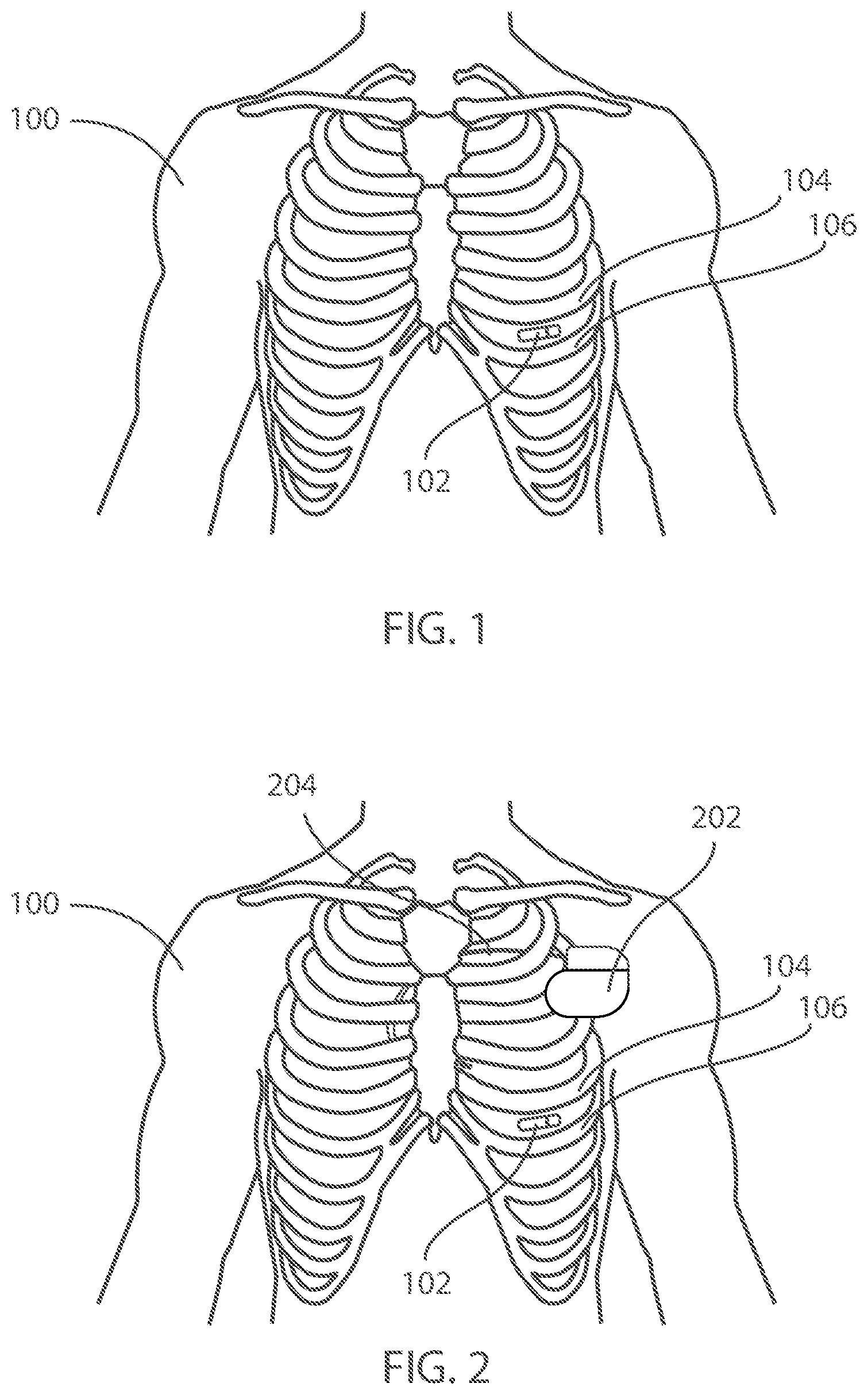 Patent US12599321 — Devices and methods for assessing pulmonary status using optical oxygenation sensing — Figure 1