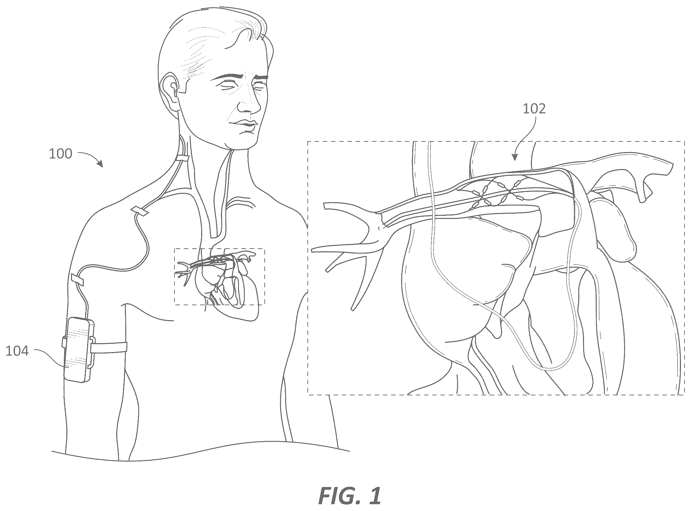 Patent US12599339 — Systems and methods for affecting cardiac contractility and/or relaxation — Figure 1