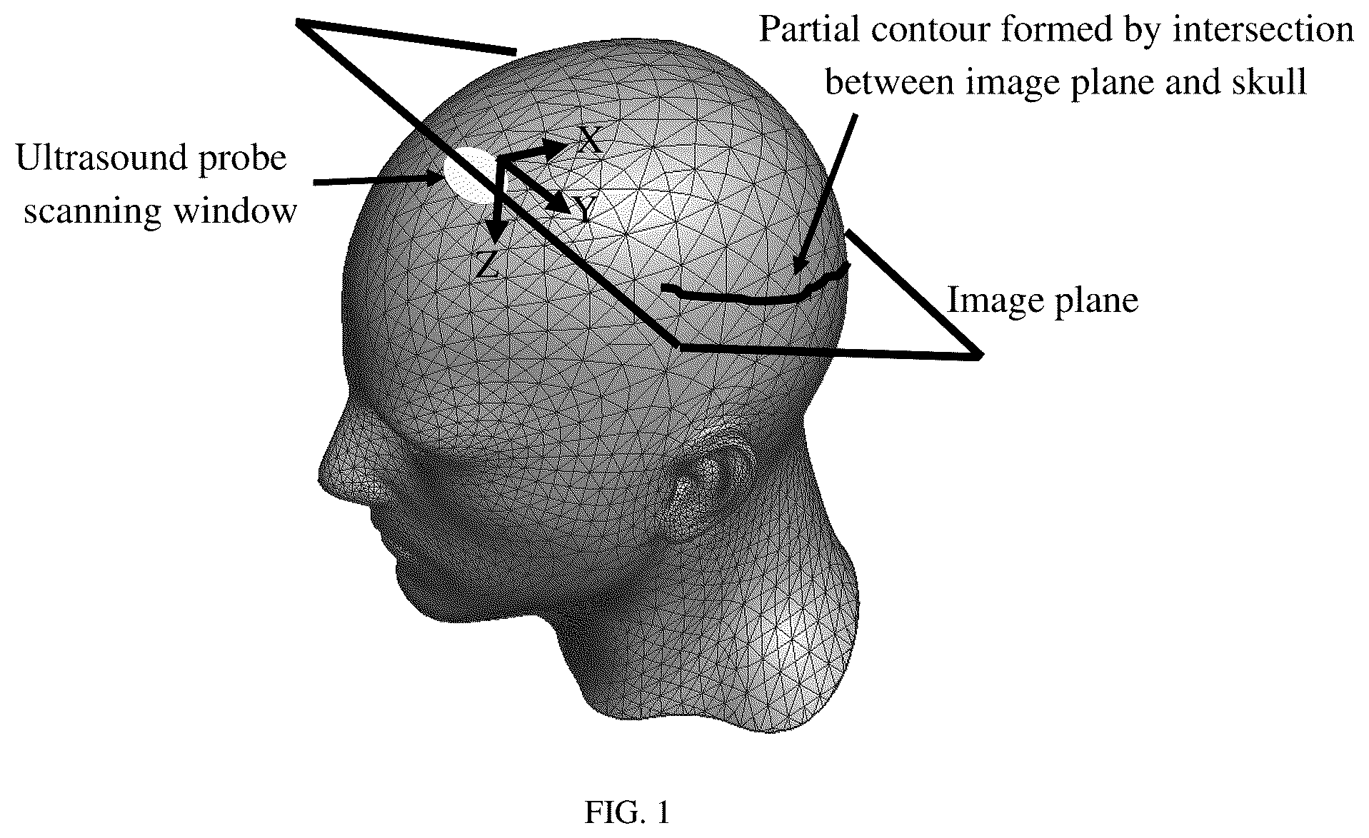 Patent US12599357 Figure 1 – Ultrasound automated detection and display method of cranial abnormal regions