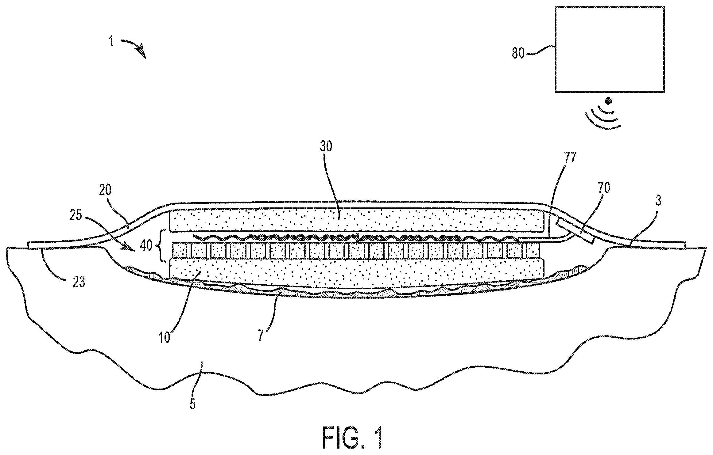 Patent US12599399 — Method and system for providing active tissue site debridement — Figure 1