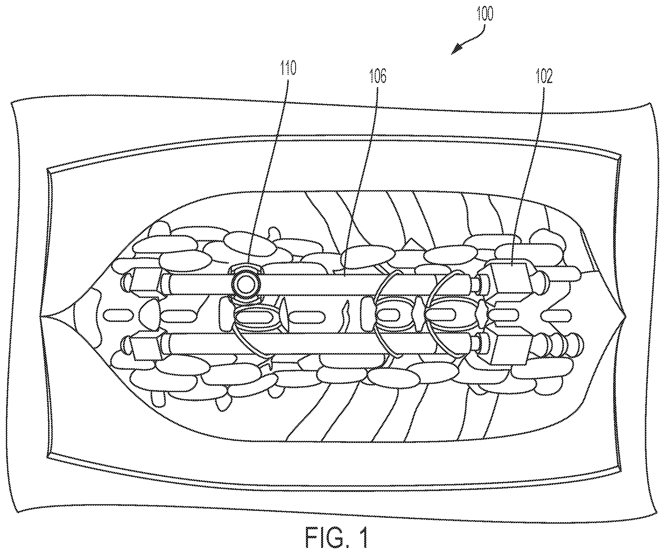 Patent US12599412 — Intra-operative options for smart implants — Figure 1