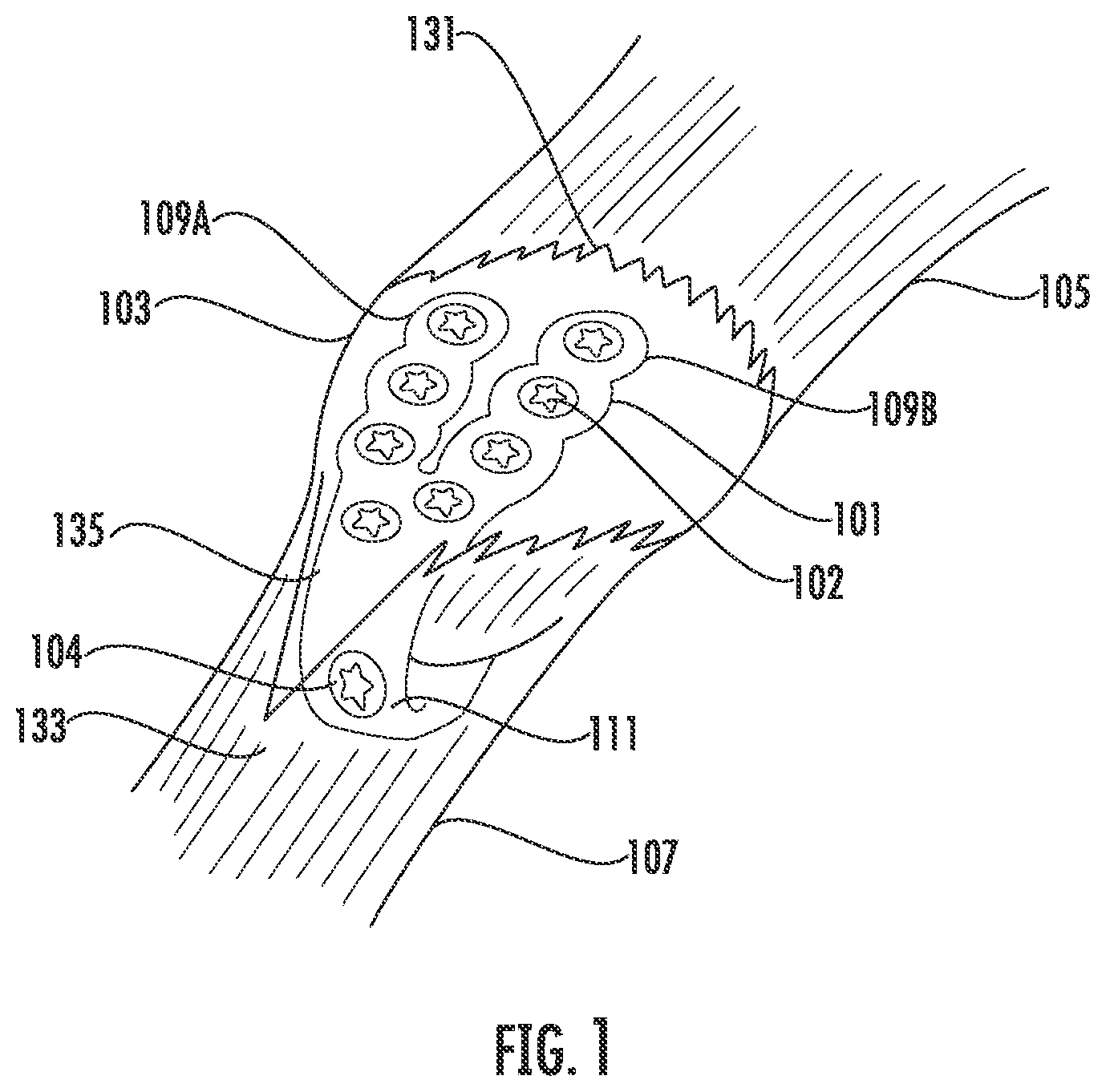 Patent US12599417 — Patella bone plate systems — Figure 1