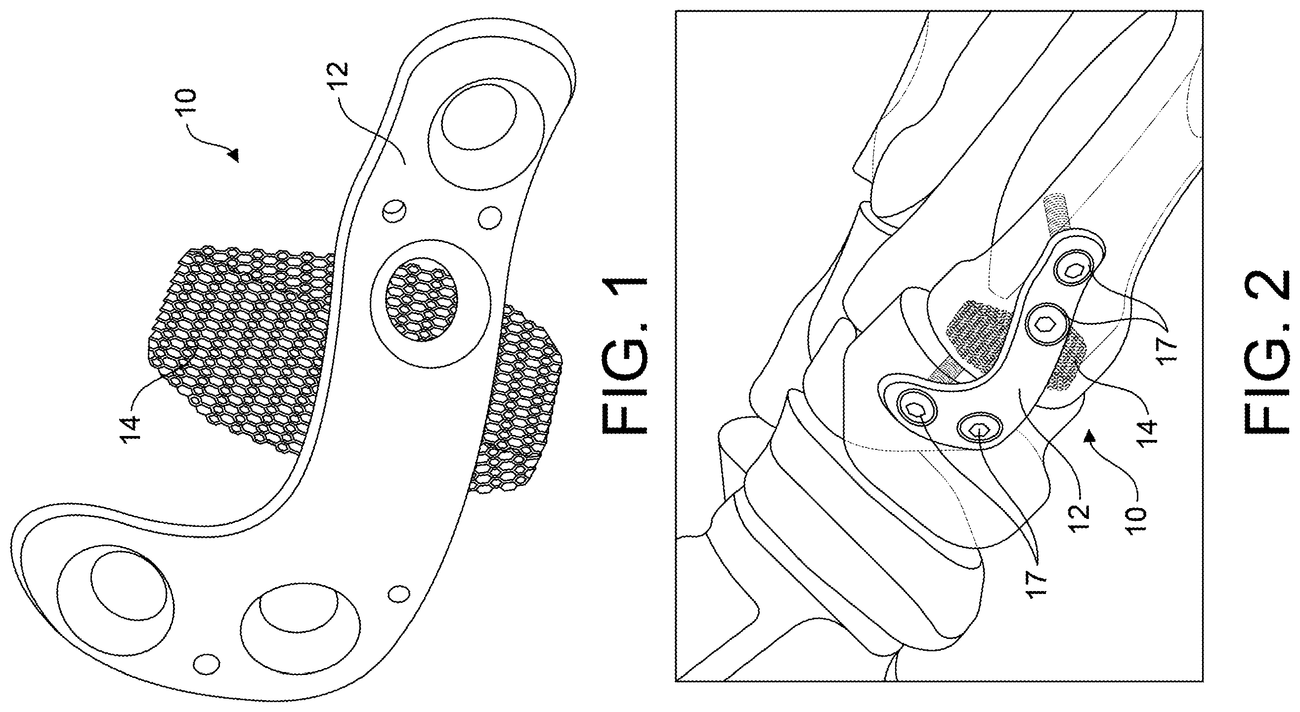 Patent US12599418 — Bone fixation devices — Figure 1