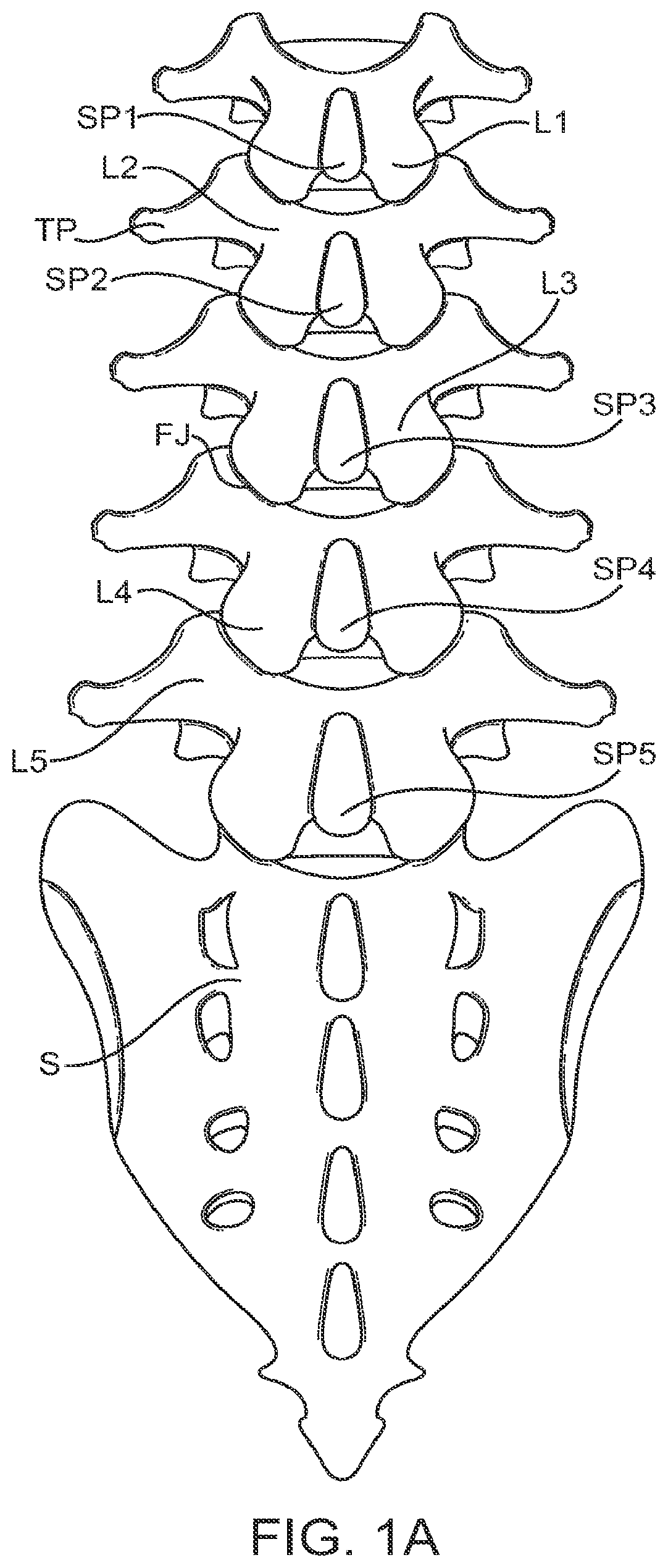 Patent US12599421 — Sacral tether anchor and methods of use — Figure 1