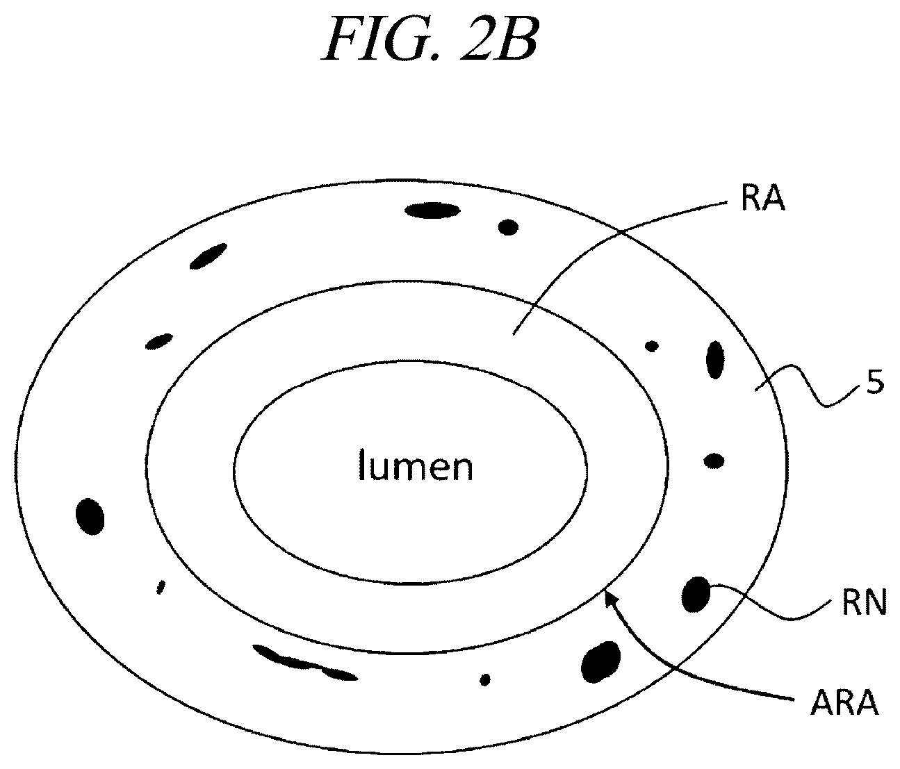 Patent US12599425 Figure 3 – Systems for perivascular nerve denervation